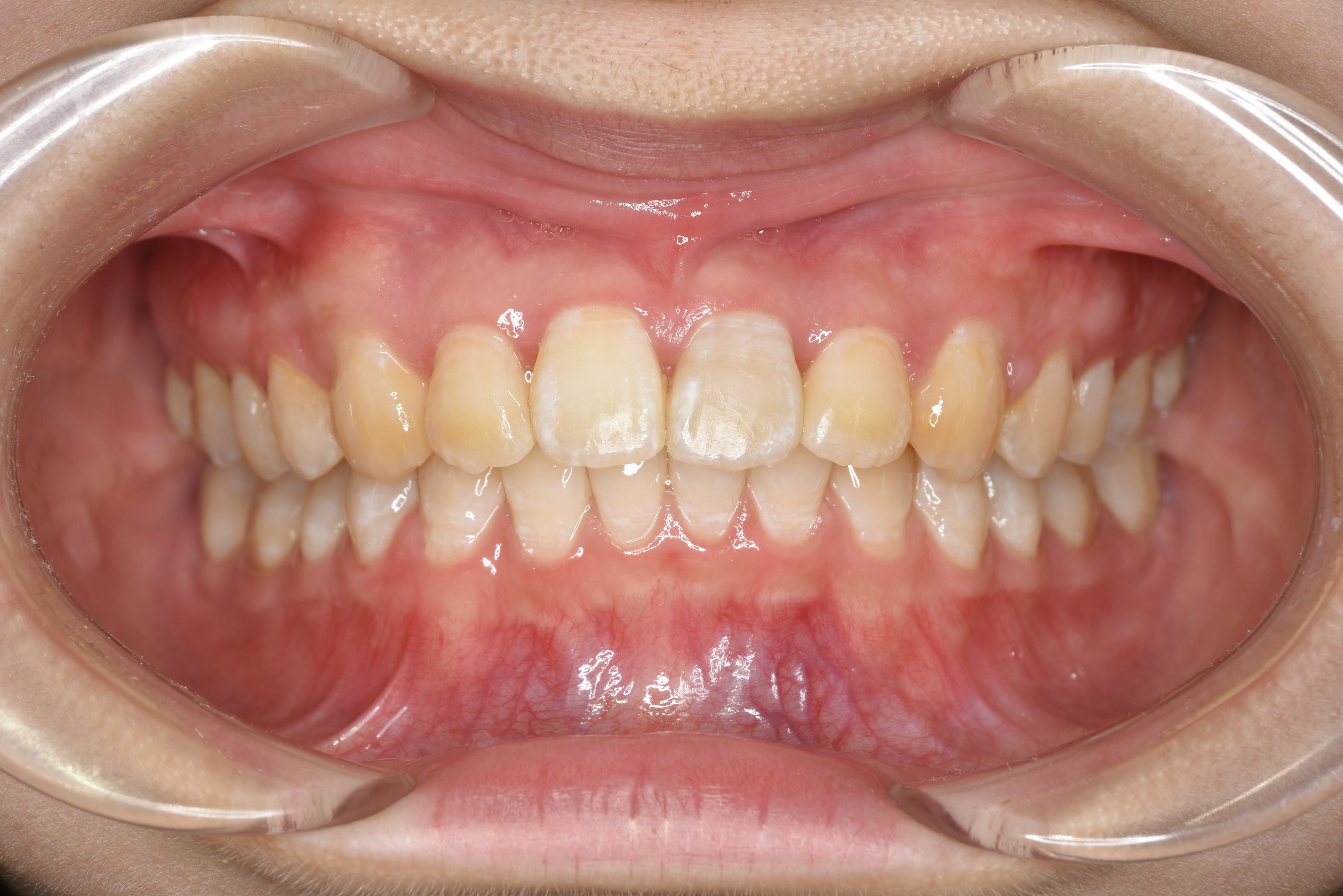 全顎ワイヤー矯正　症例_252