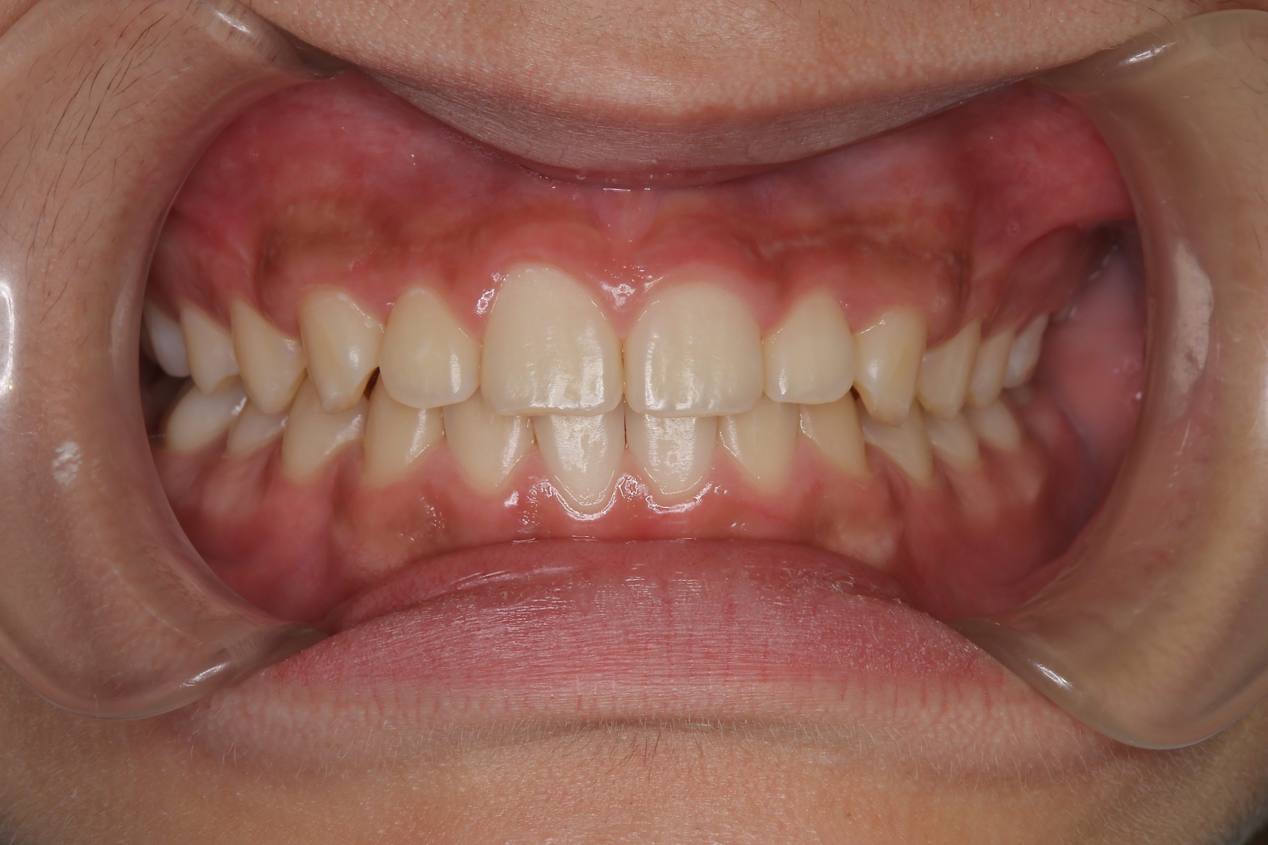 全顎ワイヤー矯正　症例_261