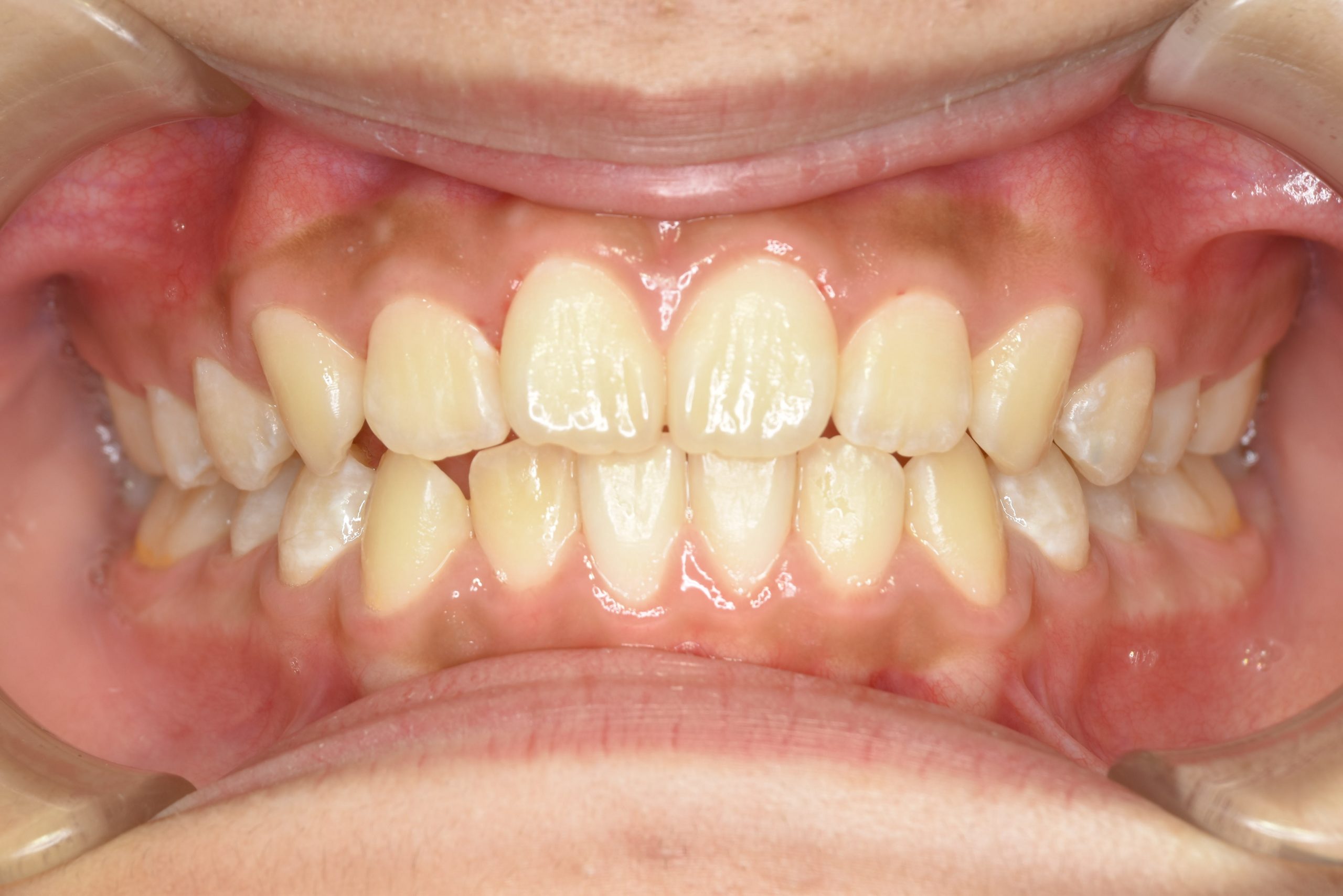 全顎ワイヤー矯正　症例_267