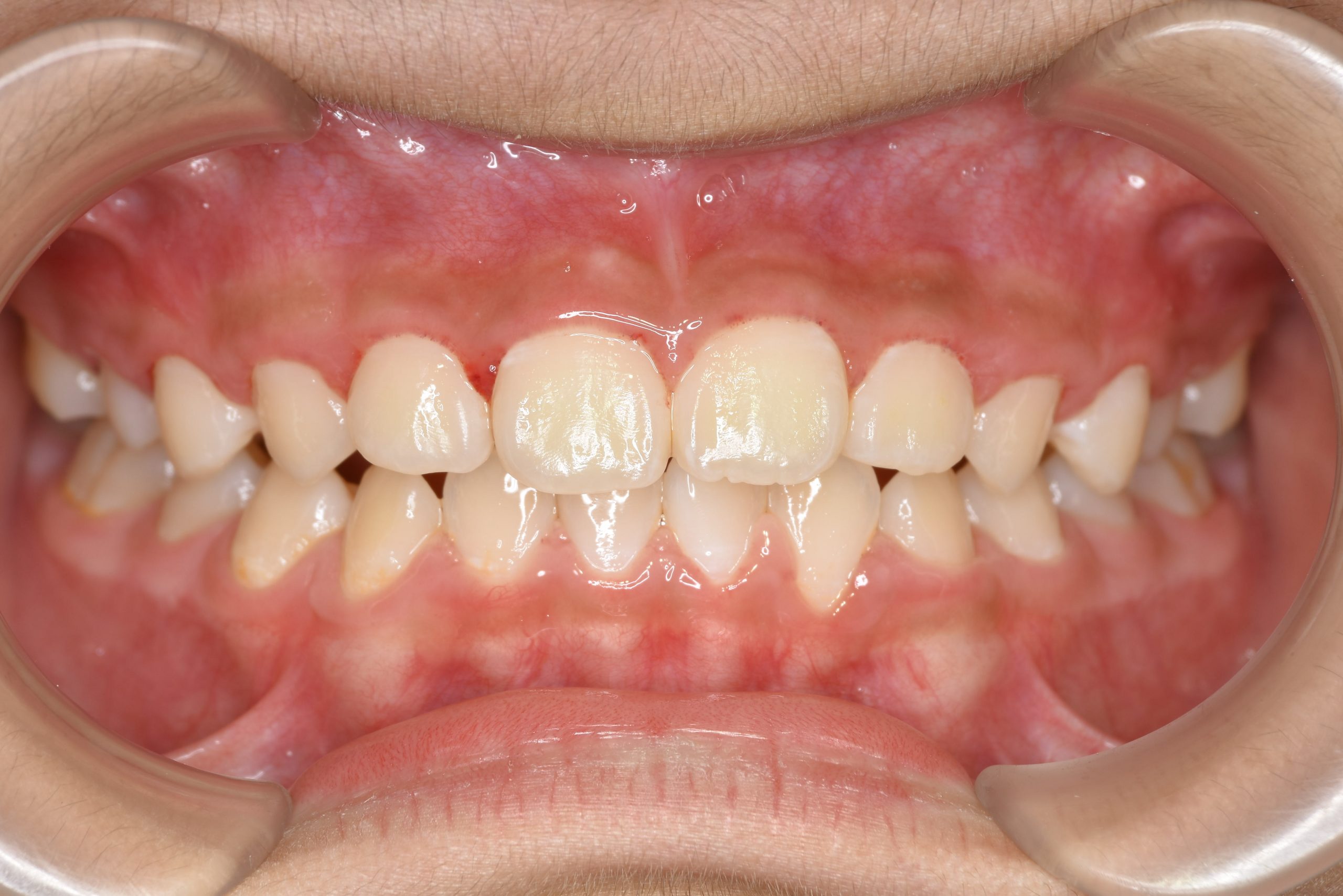 全顎ワイヤー矯正　症例_276