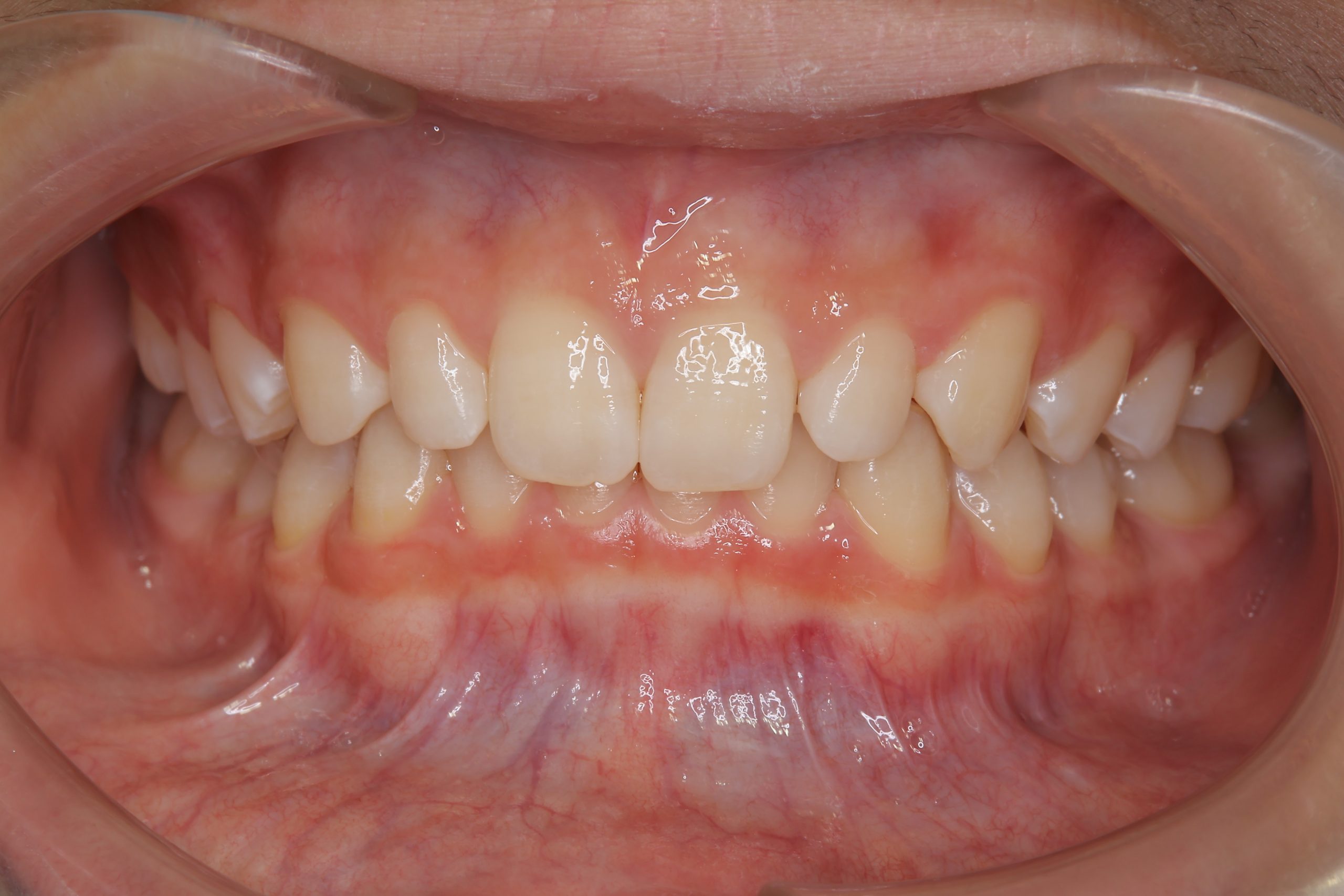 全顎ワイヤー矯正　症例_121