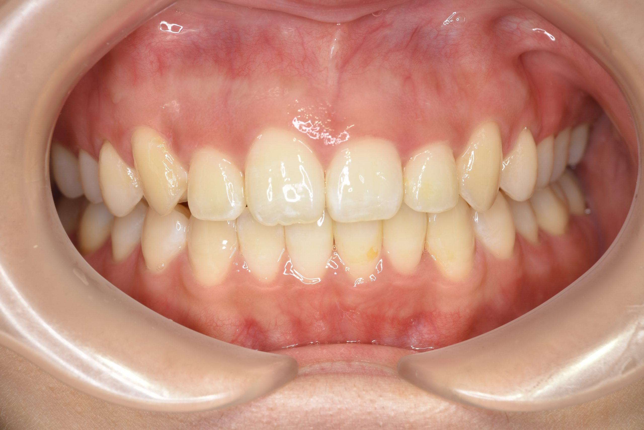 全顎ワイヤー矯正　症例_306