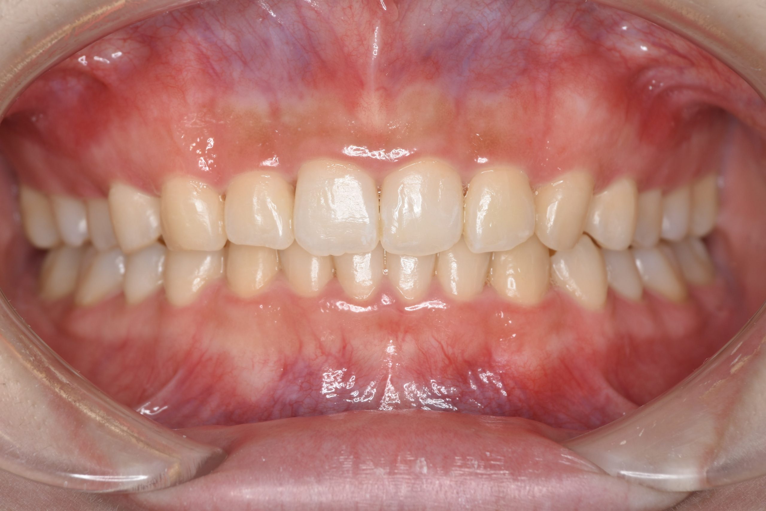 全顎ワイヤー矯正　症例_315