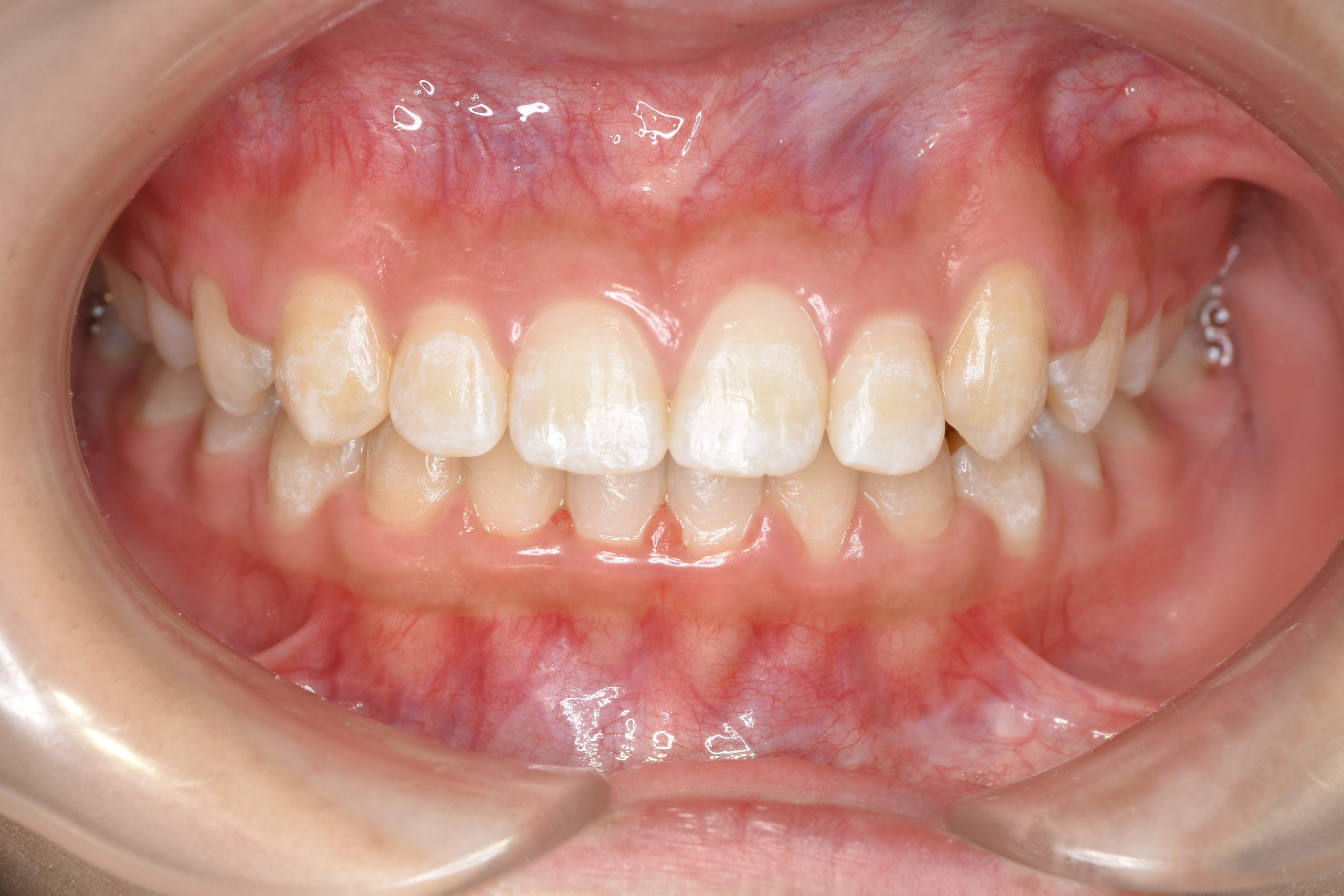 全顎ワイヤー矯正　症例_320