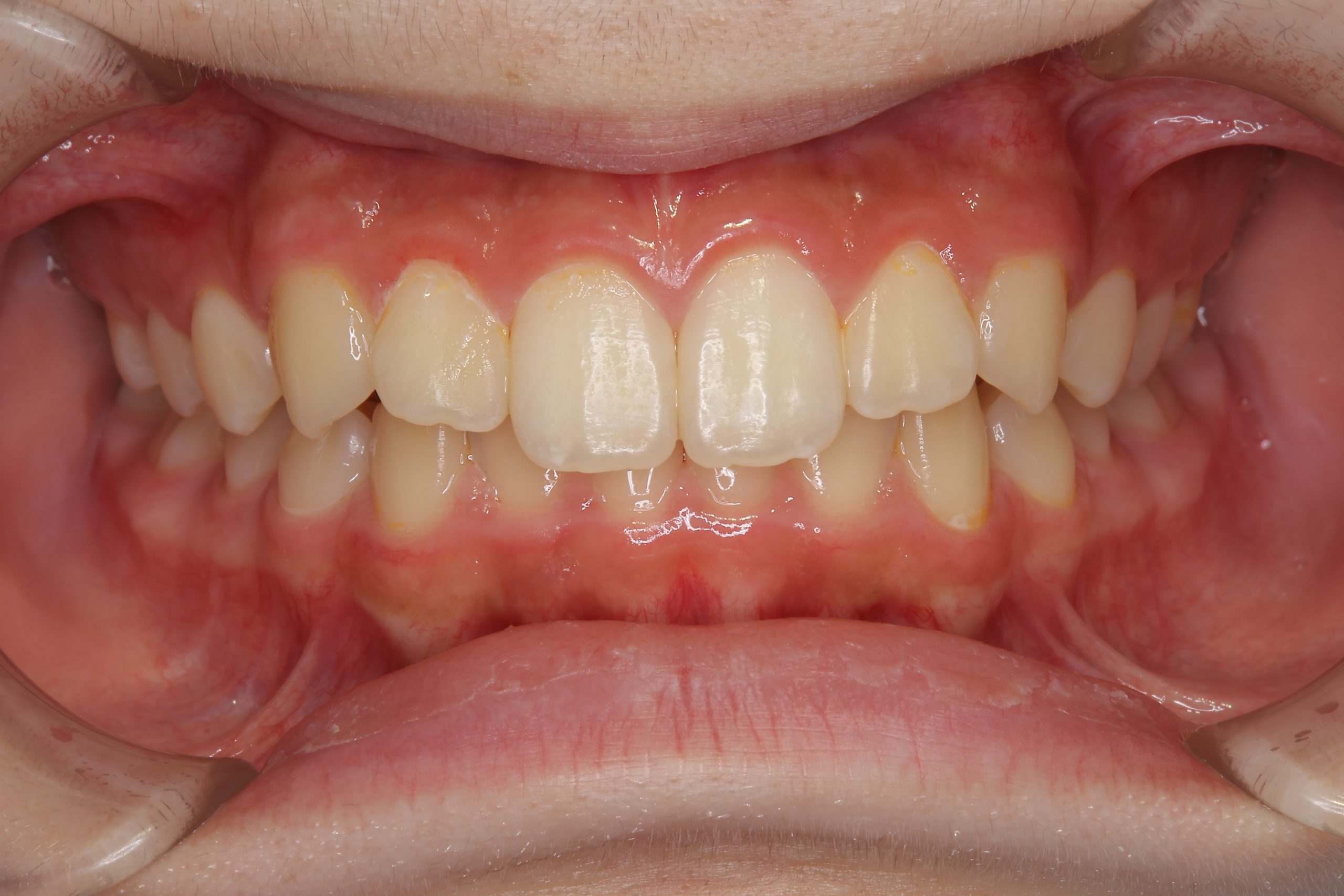 全顎ワイヤー矯正　症例_347