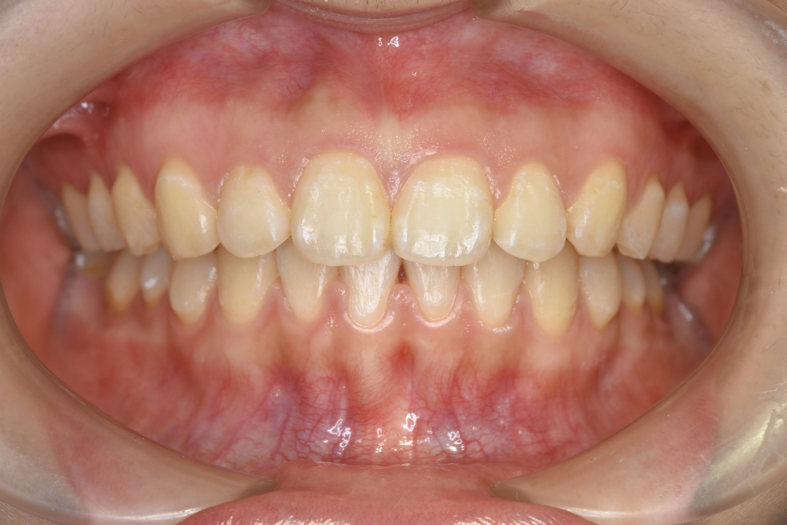 全顎ワイヤー矯正　症例_349