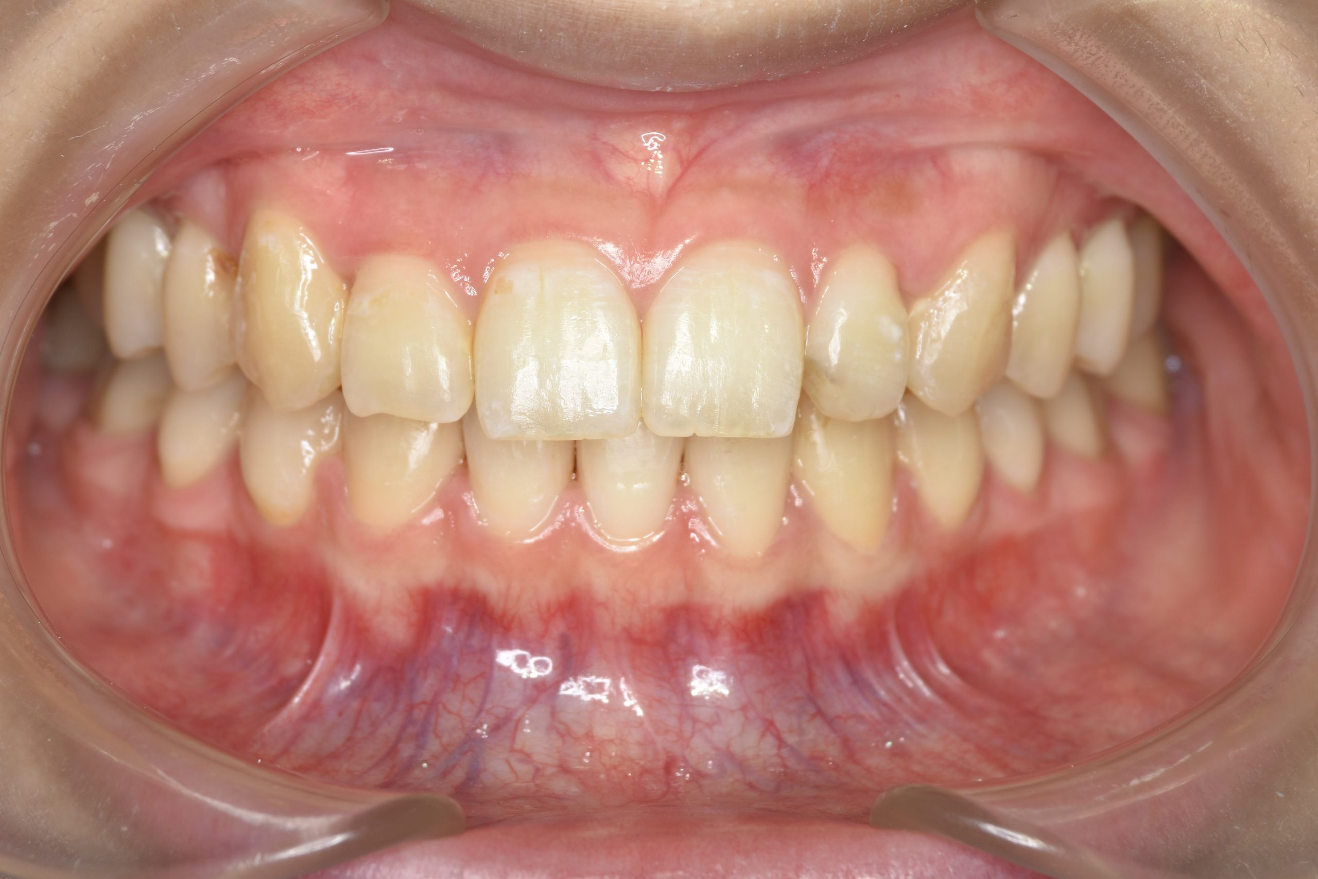 全顎ワイヤー矯正　症例_401