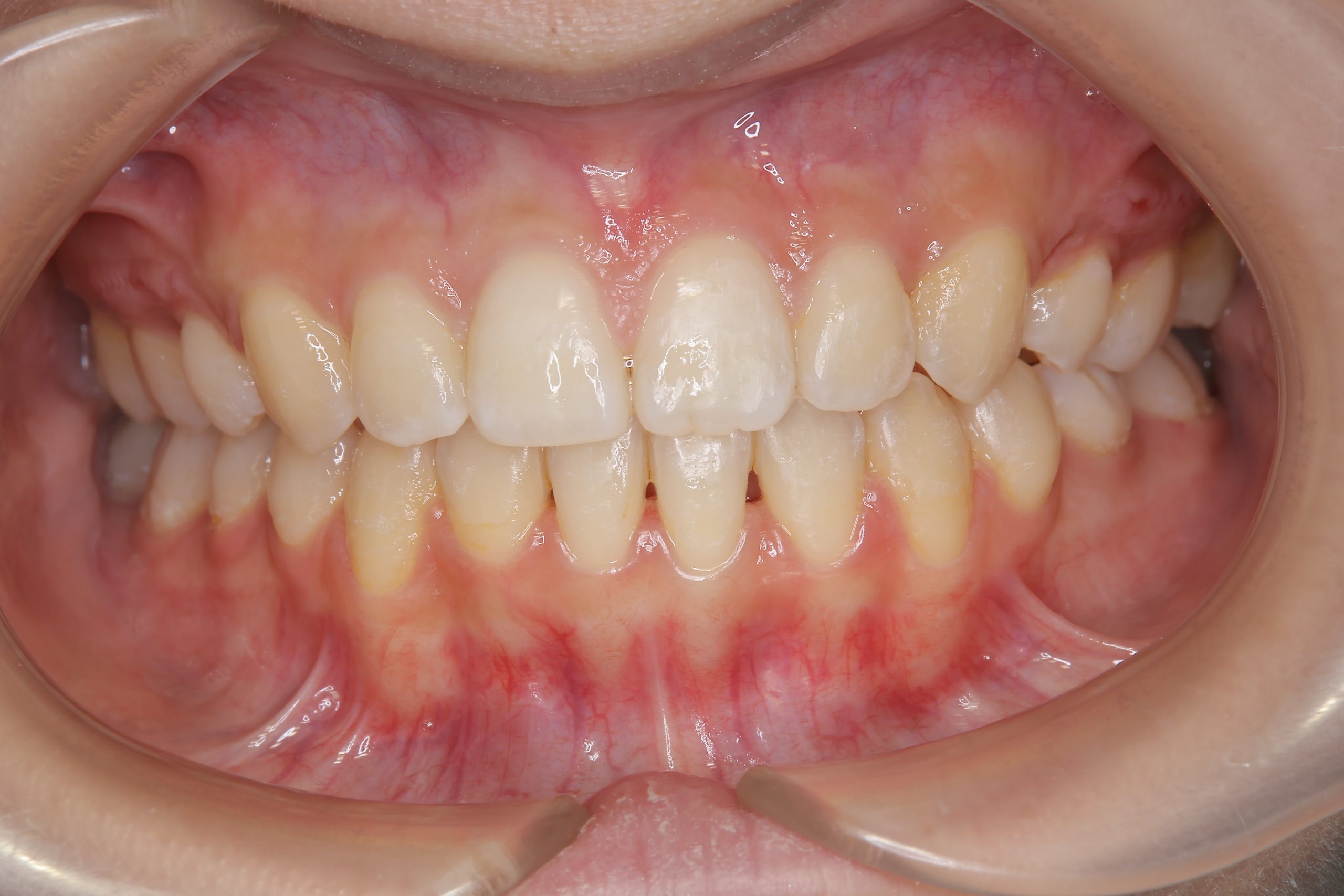 全顎ワイヤー矯正　症例_418