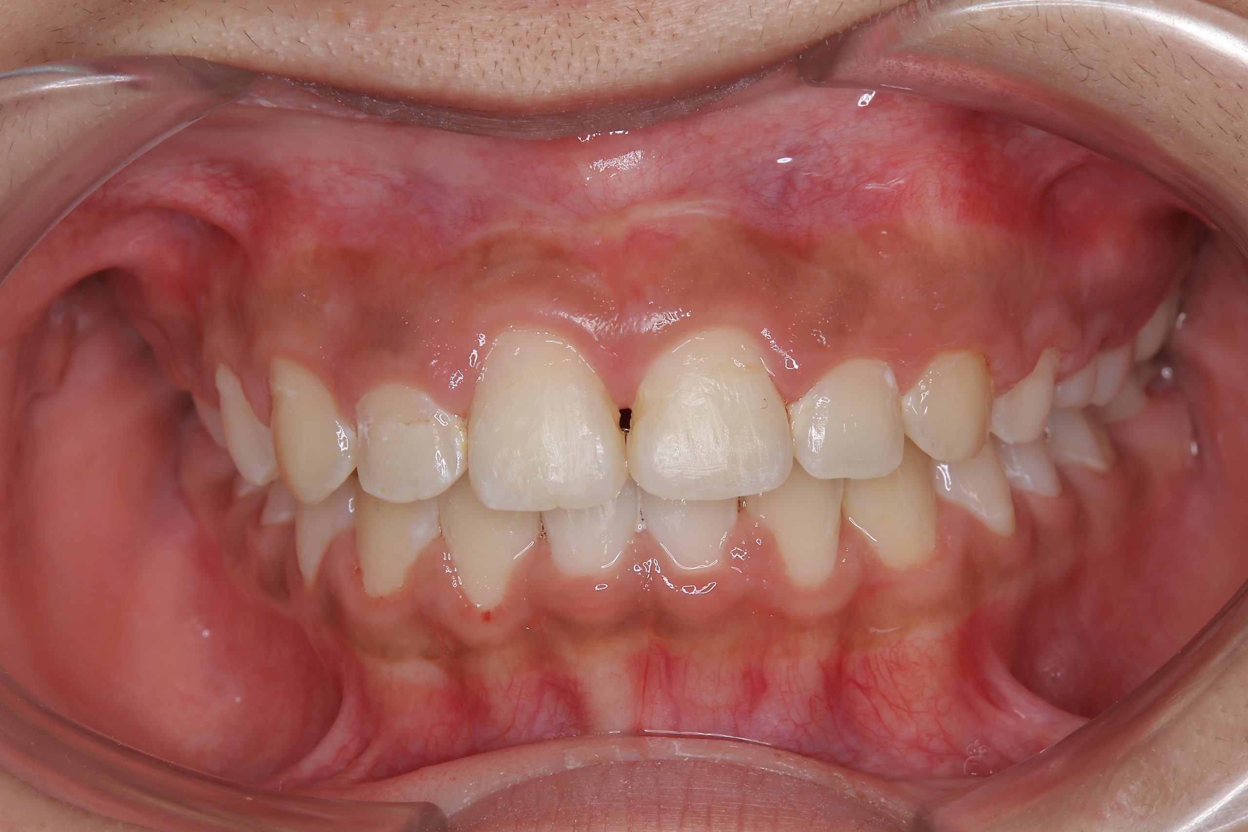 全顎ワイヤー矯正　症例_474