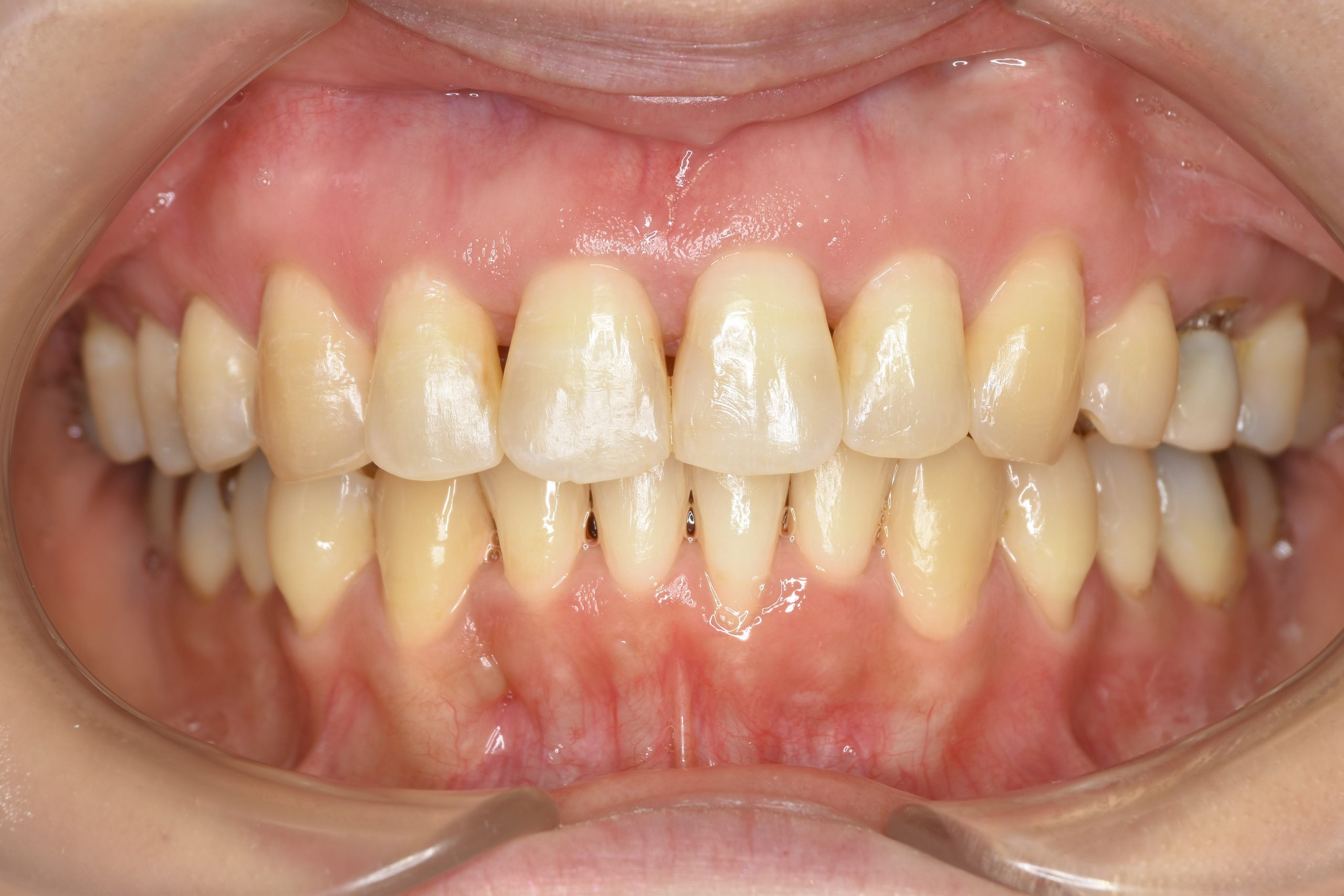 全顎ワイヤー矯正　症例_479