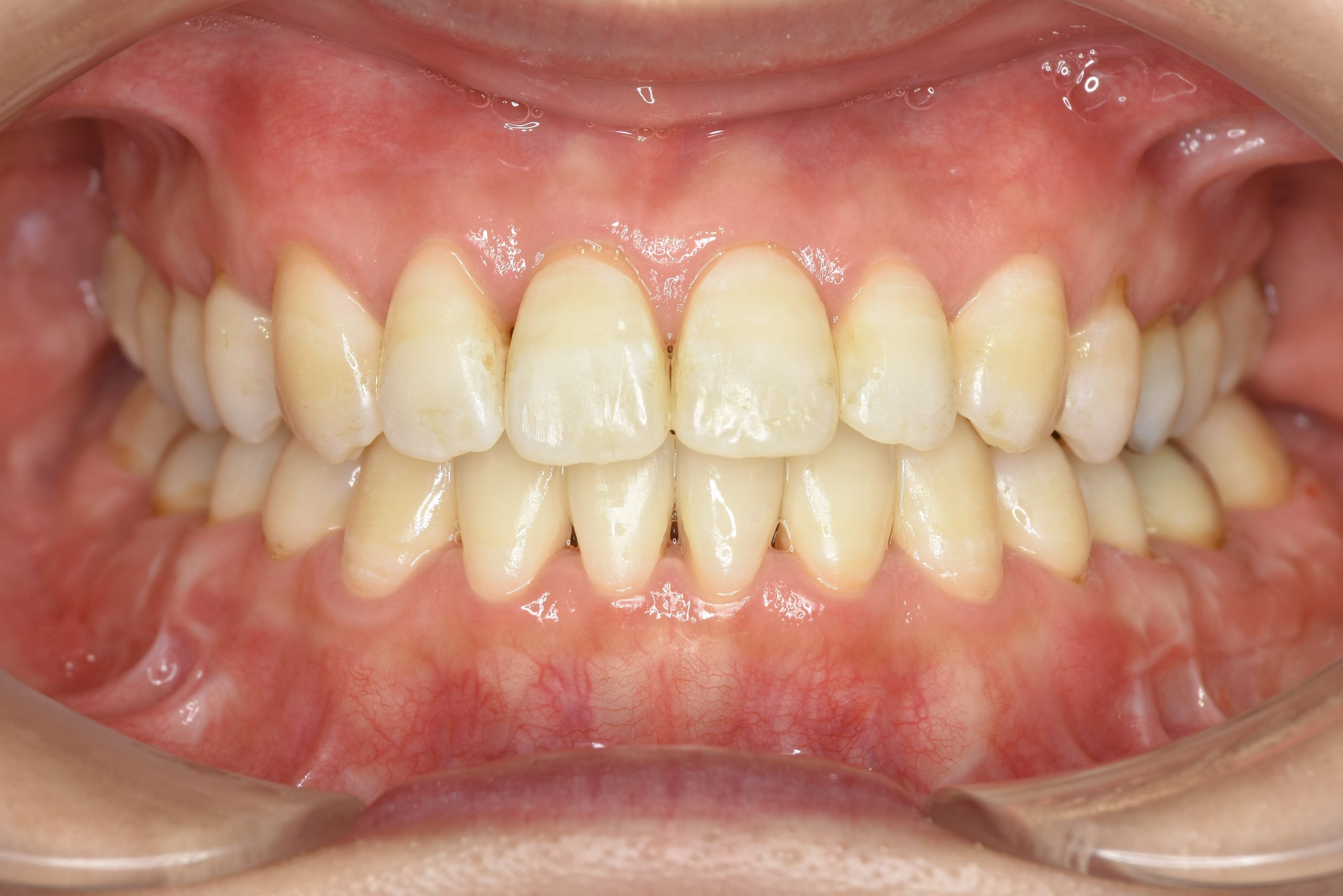 全顎ワイヤー矯正　症例_138