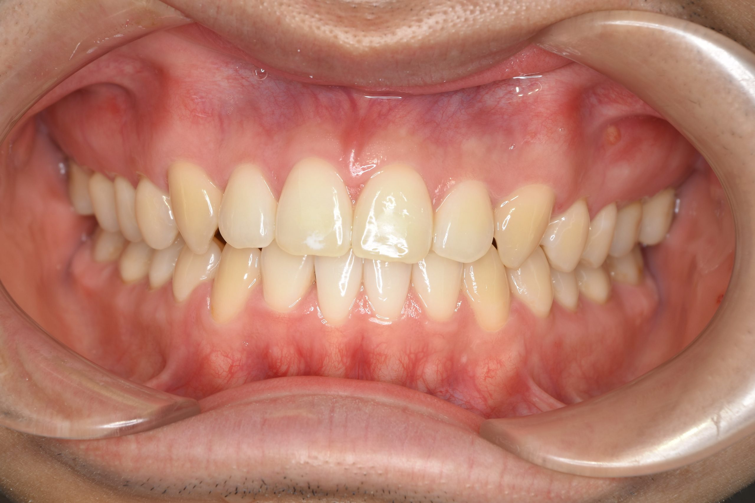 全顎ワイヤー矯正　症例_495