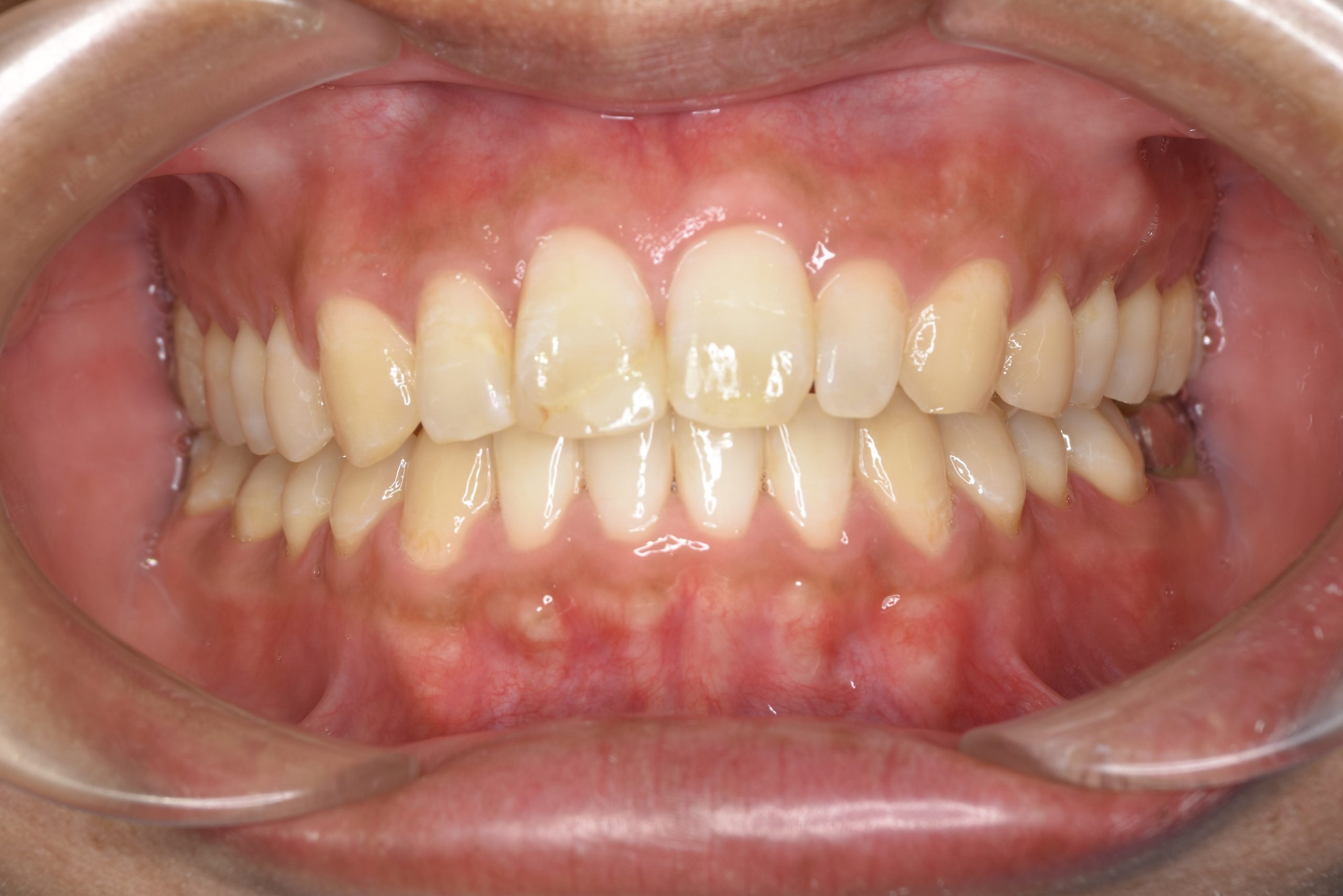 全顎ワイヤー矯正　症例_510