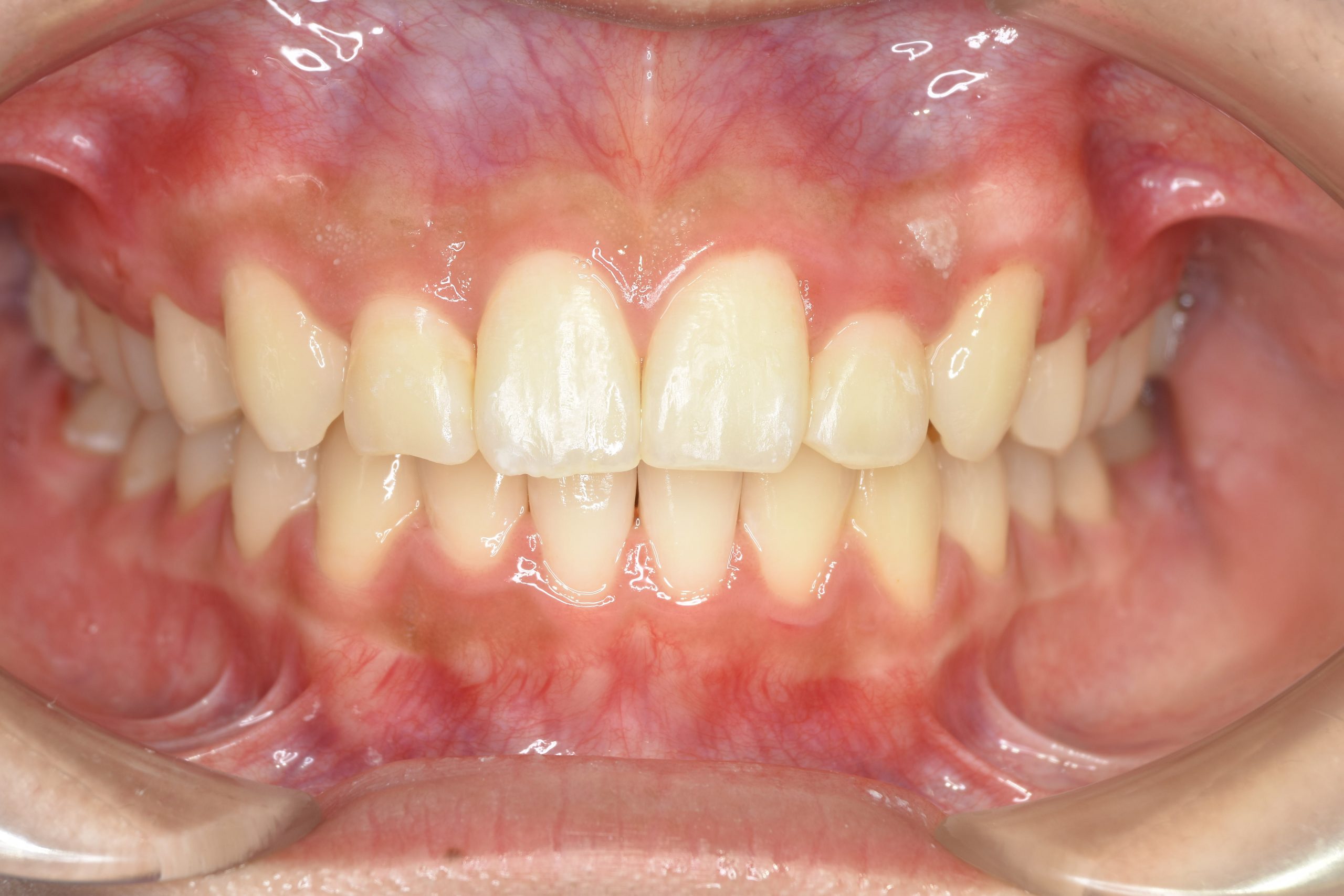 全顎ワイヤー矯正　症例_551