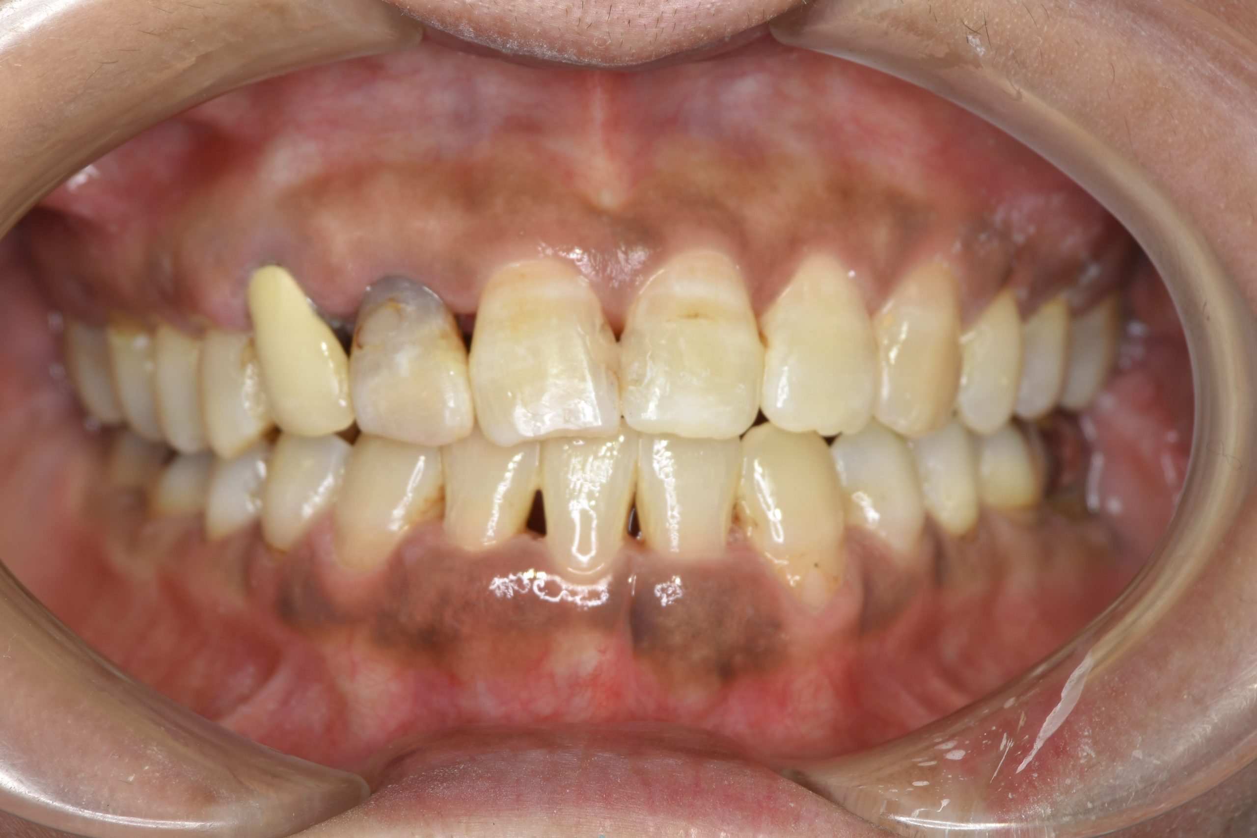 全顎ワイヤー矯正　症例_588