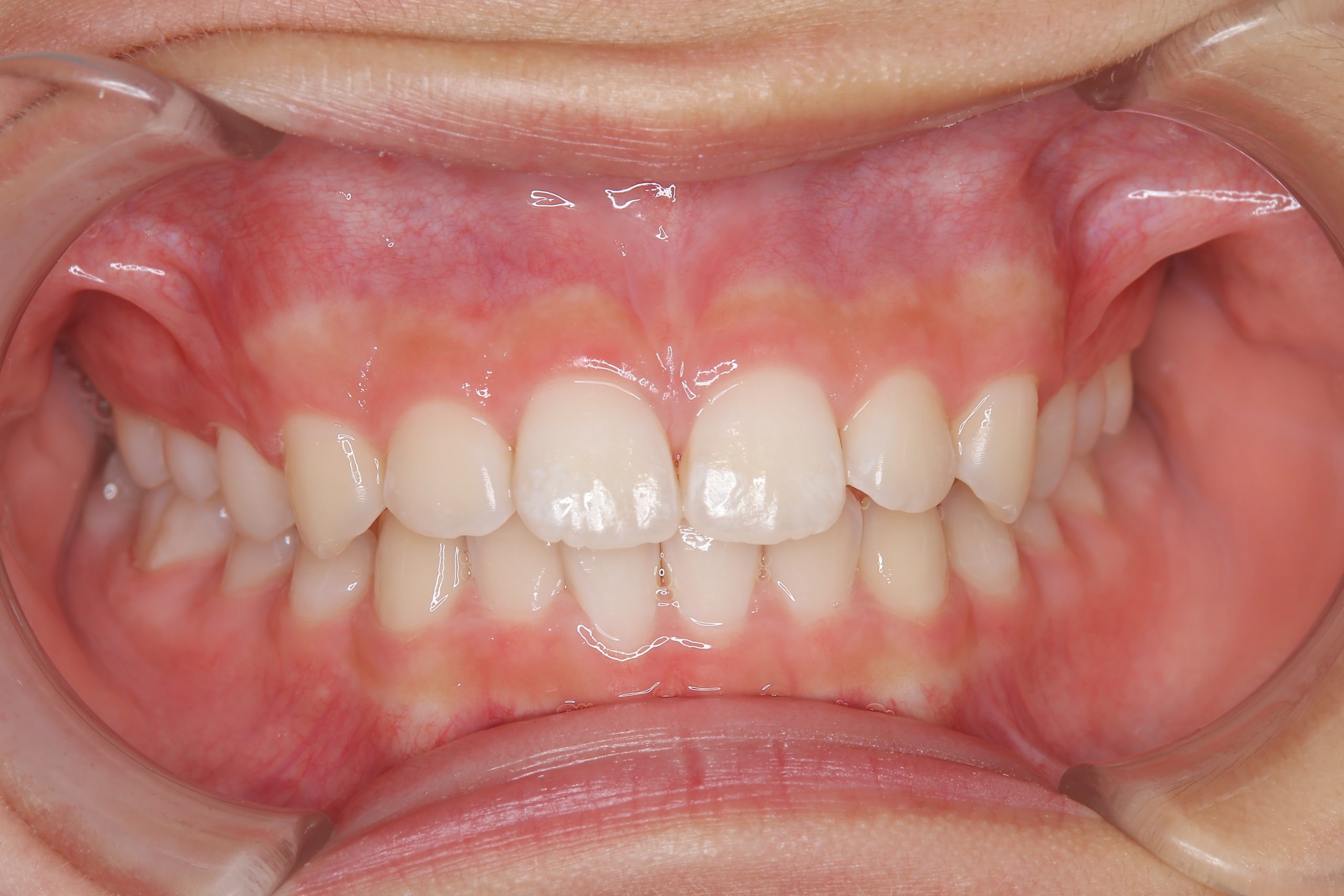 全顎ワイヤー矯正　症例_610