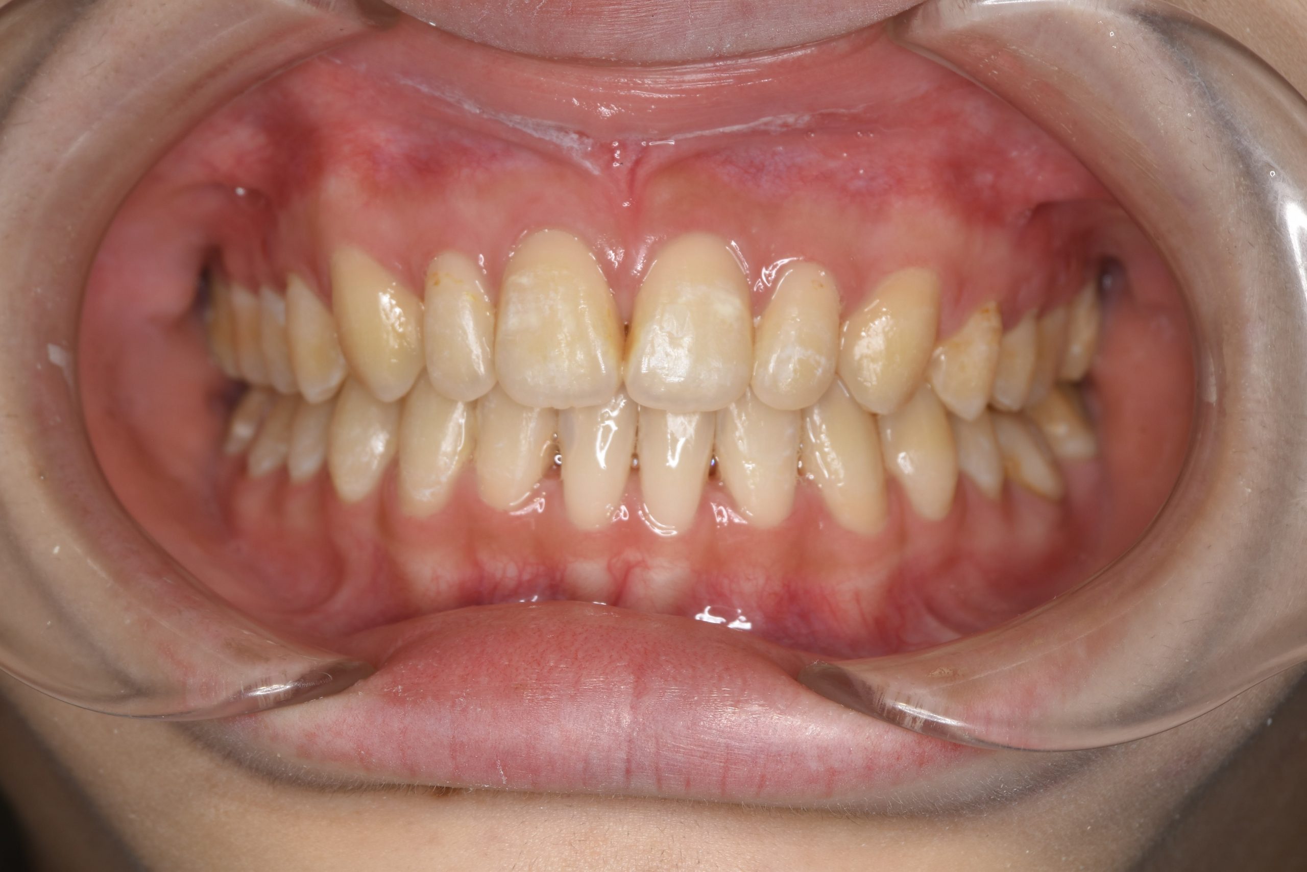 全顎ワイヤー矯正　症例_640