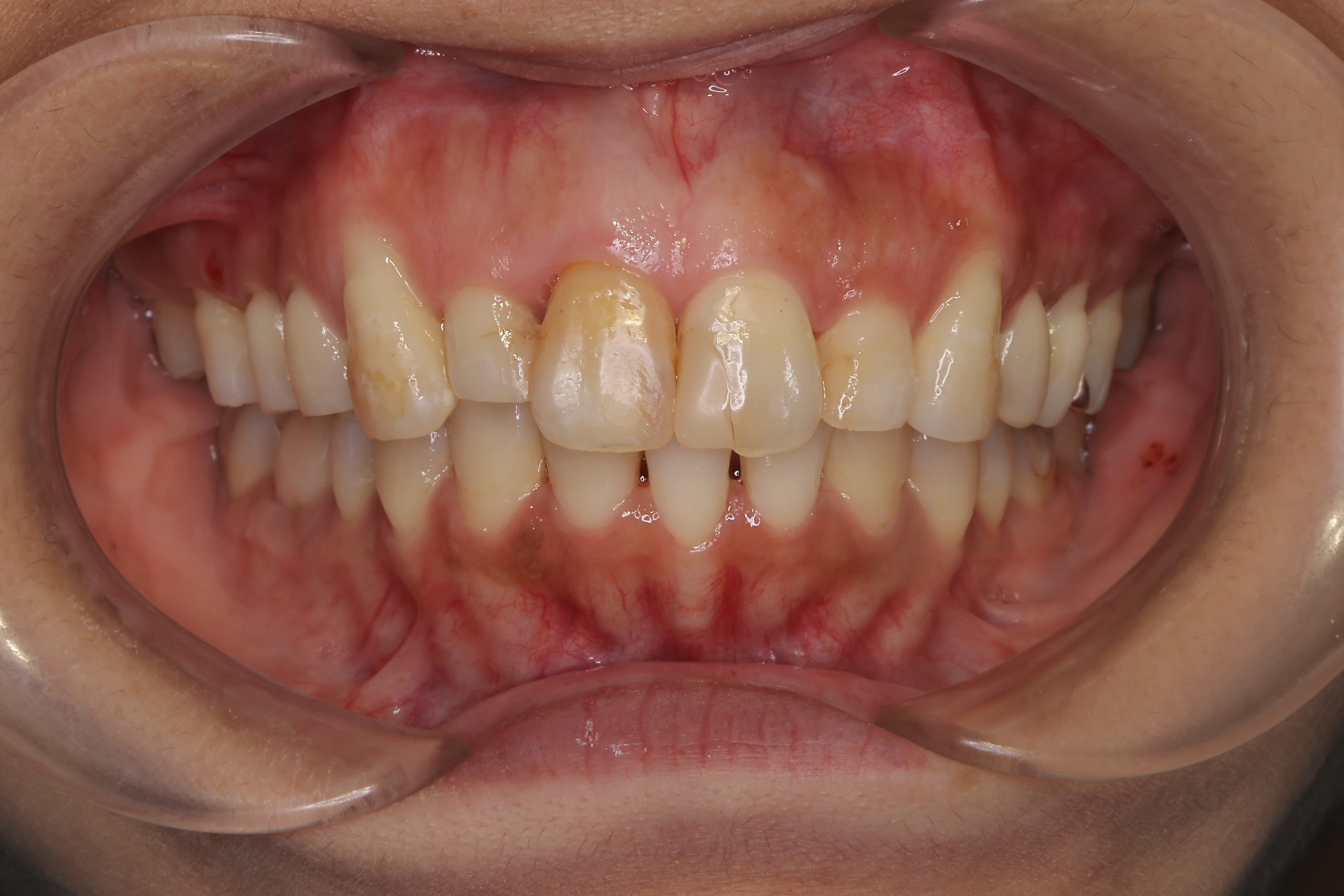 全顎ワイヤー矯正　症例_649