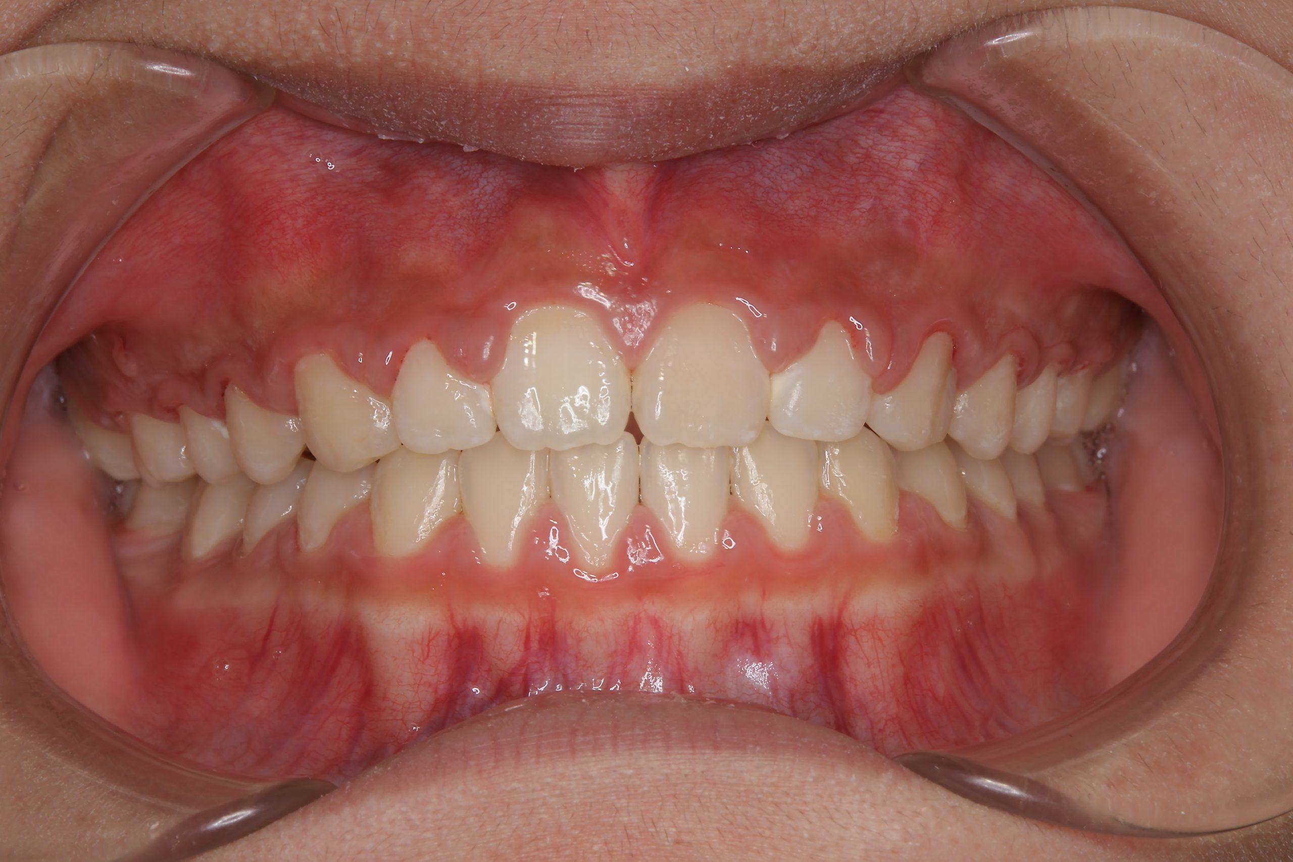 全顎ワイヤー矯正　症例_681