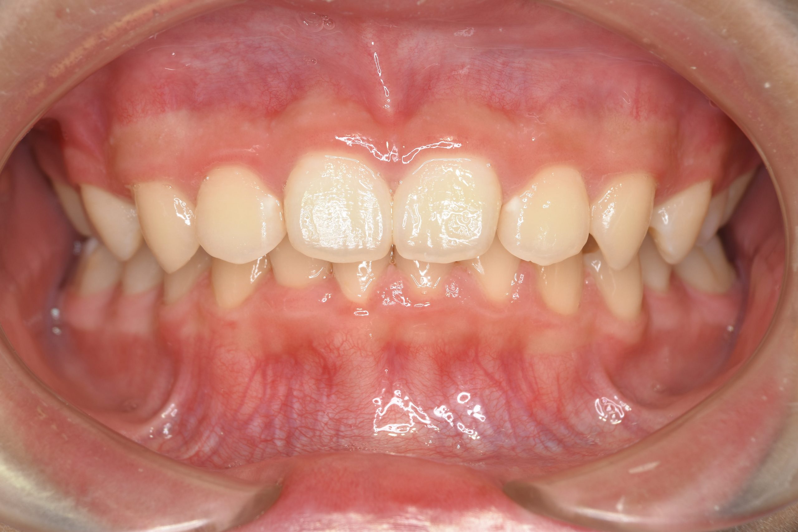 全顎ワイヤー矯正　症例_758