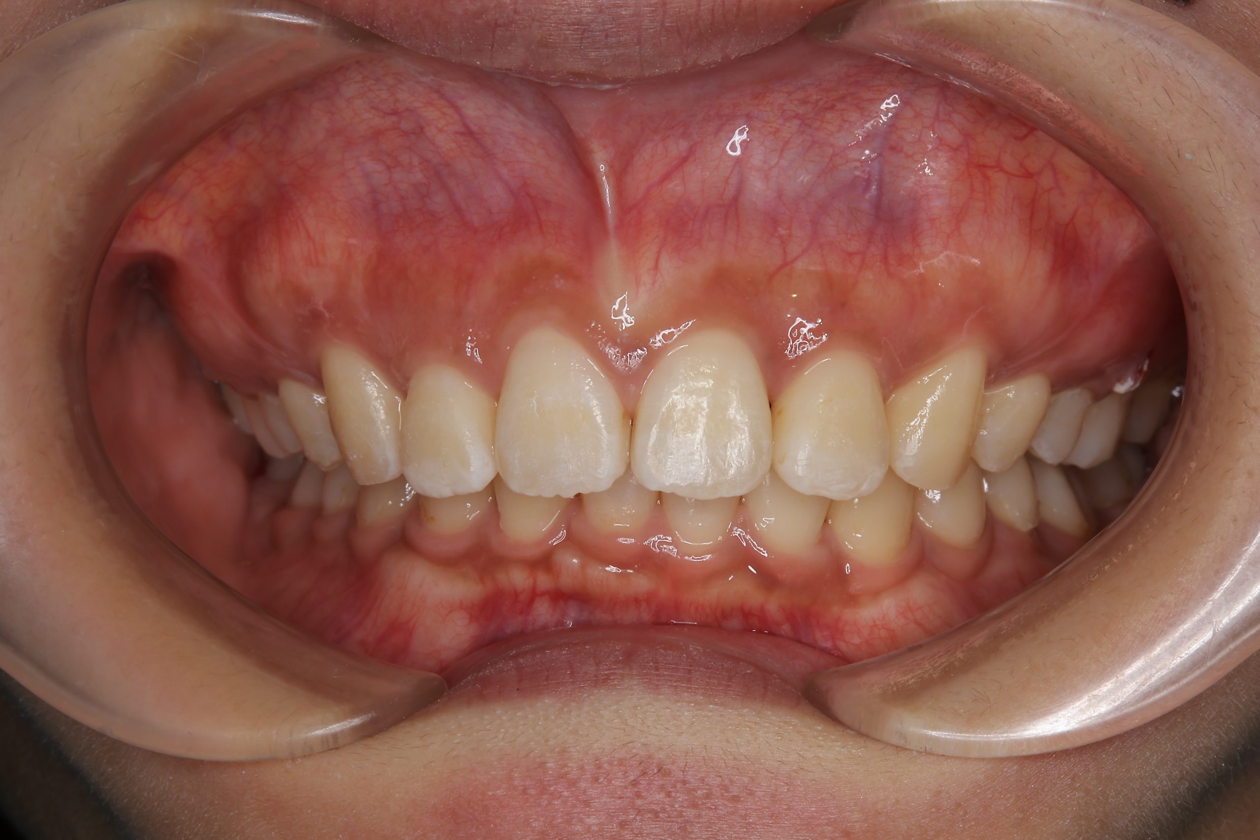 全顎ワイヤー矯正　症例_793