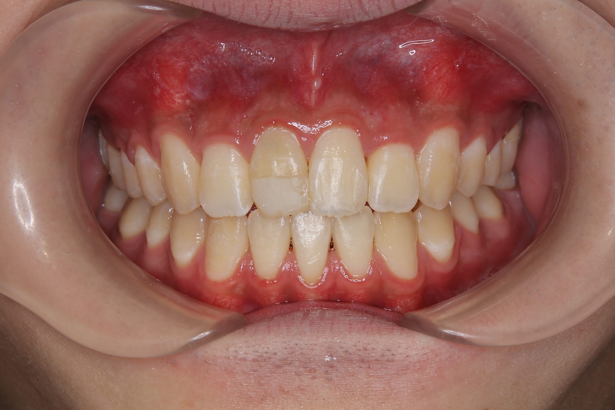 全顎ワイヤー矯正　症例_798