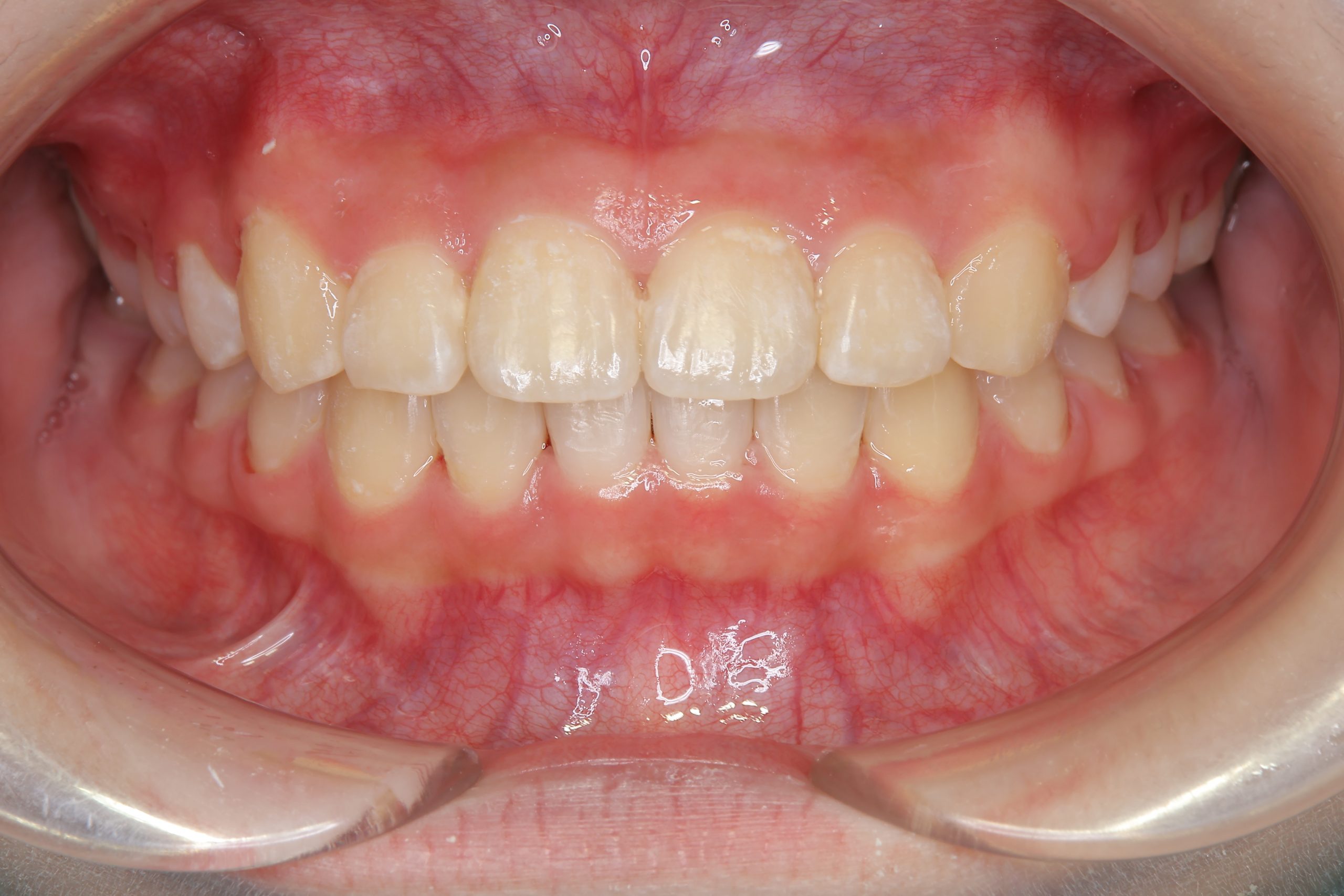 全顎ワイヤー矯正　症例_805