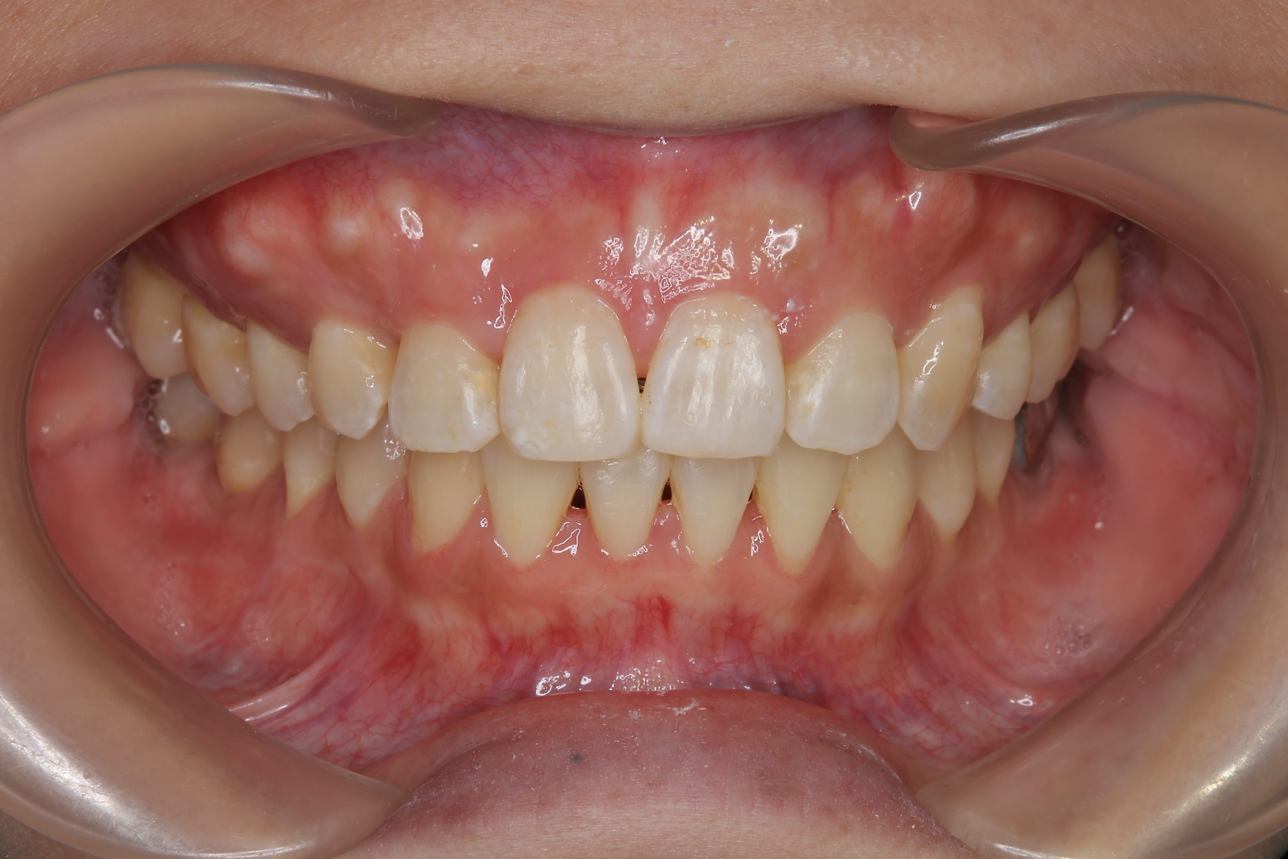 全顎ワイヤー矯正　症例_814