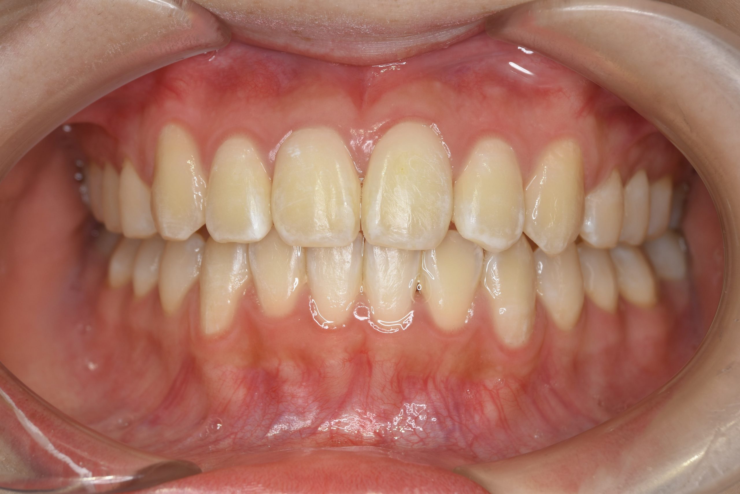 全顎ワイヤー矯正　症例_815