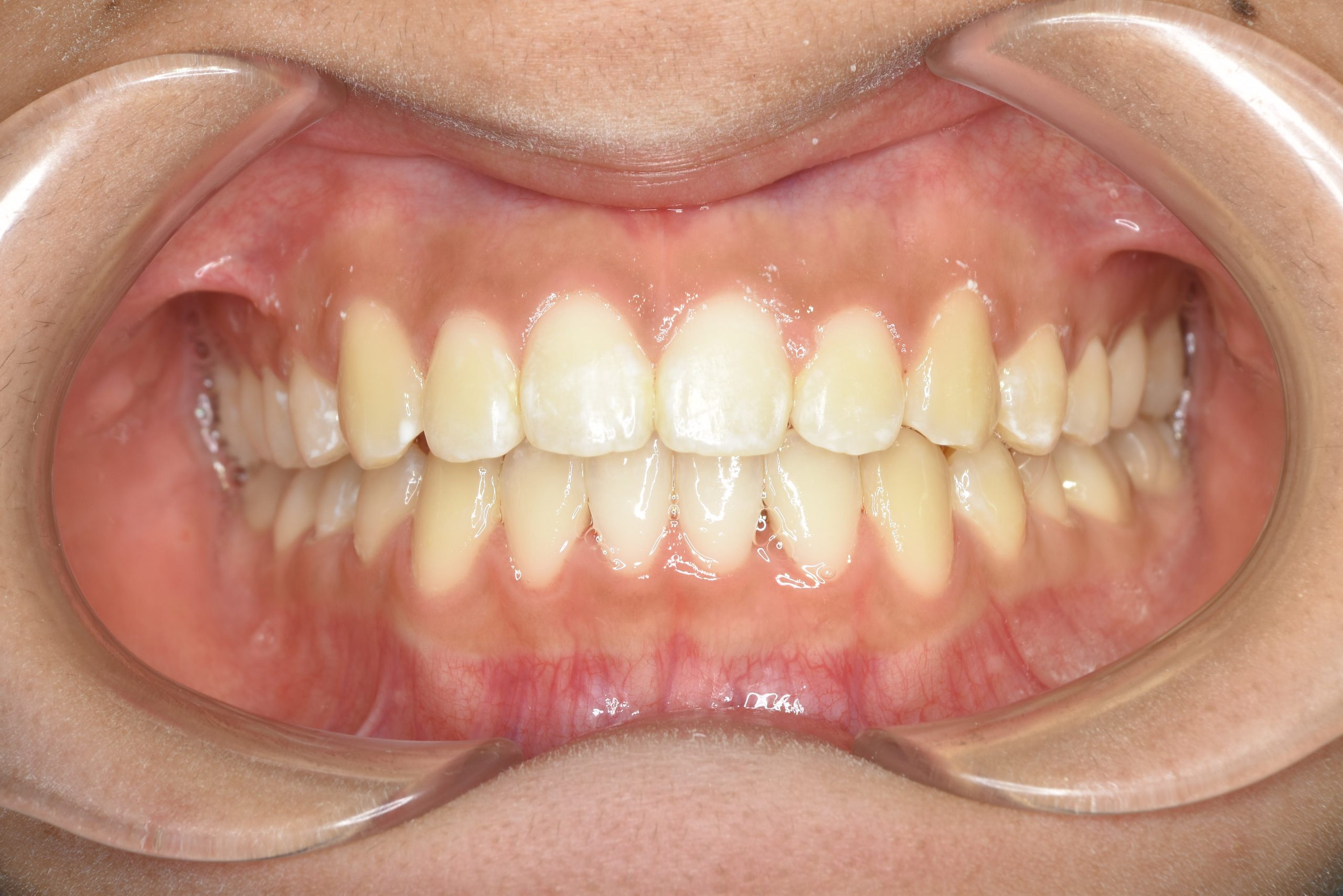 全顎ワイヤー矯正　症例_839