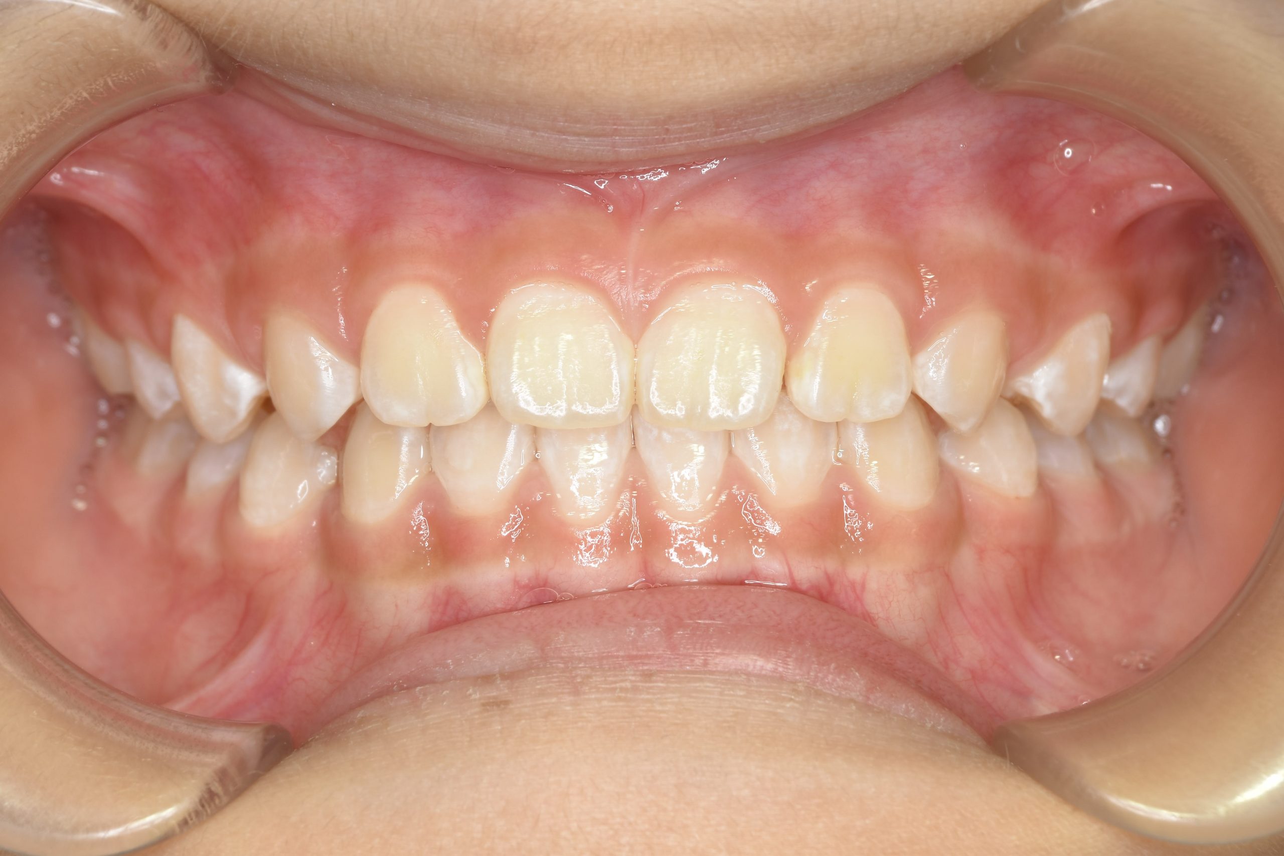 全顎ワイヤー矯正　症例_858