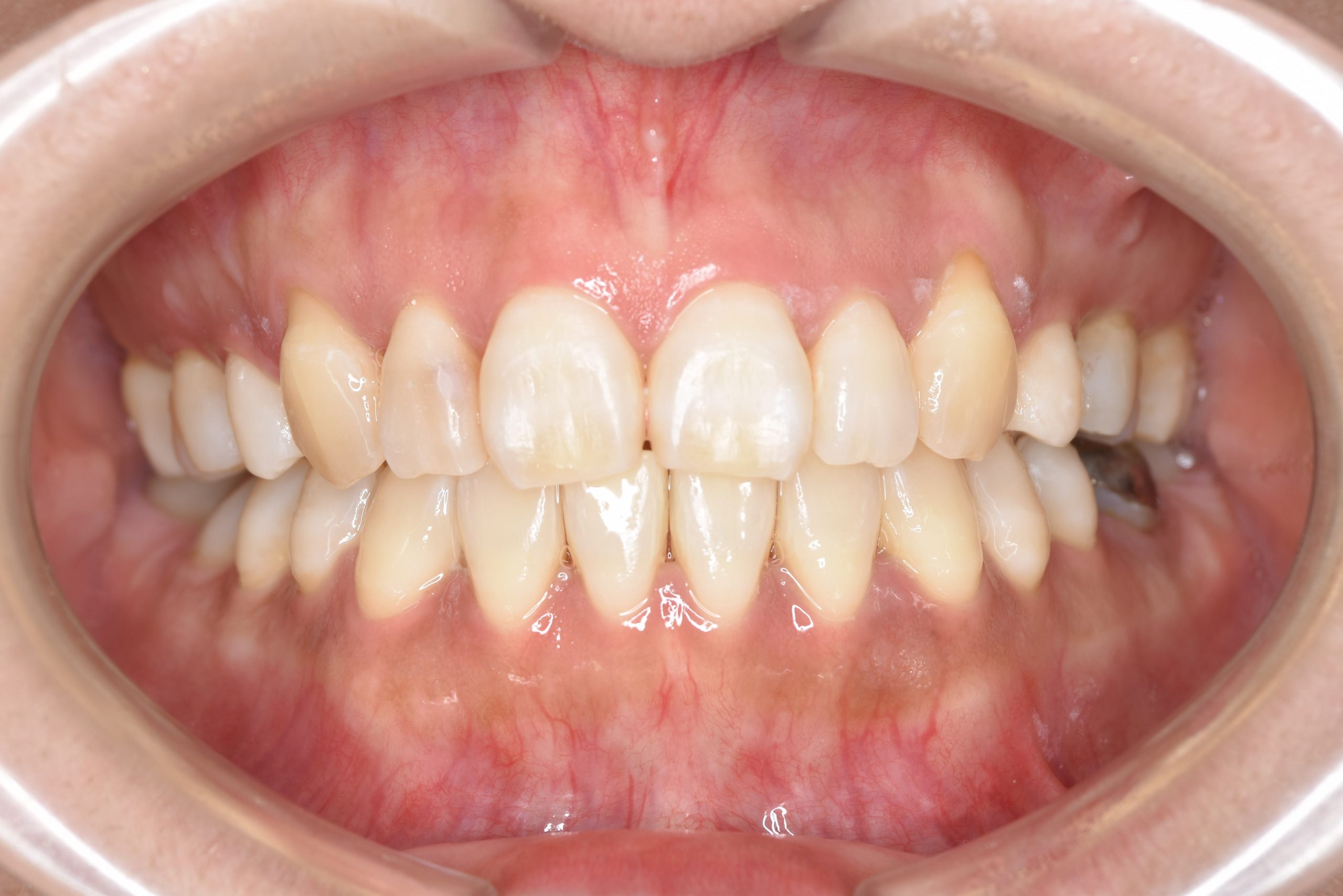 全顎ワイヤー矯正　症例_141