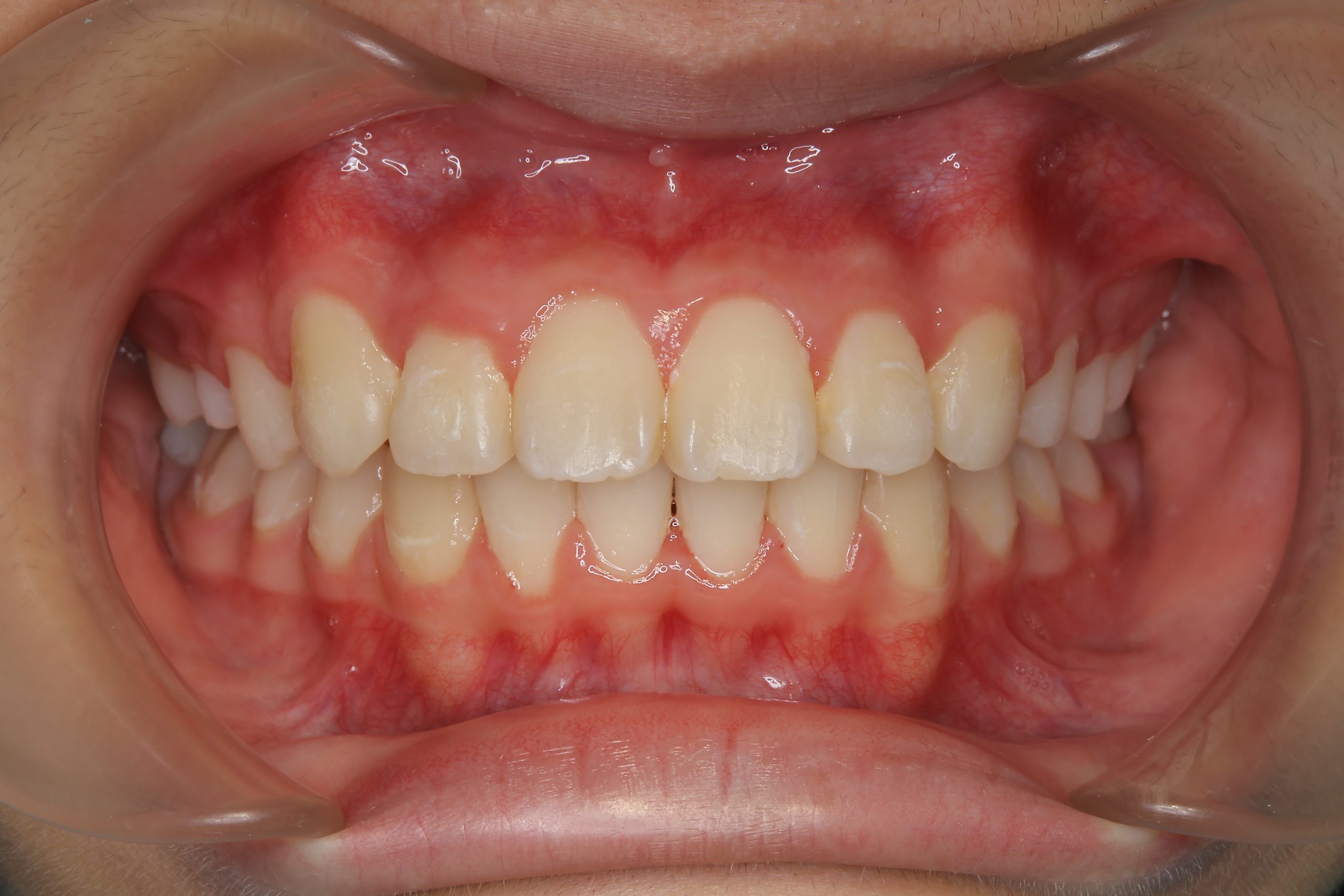 全顎ワイヤー矯正　症例_1324