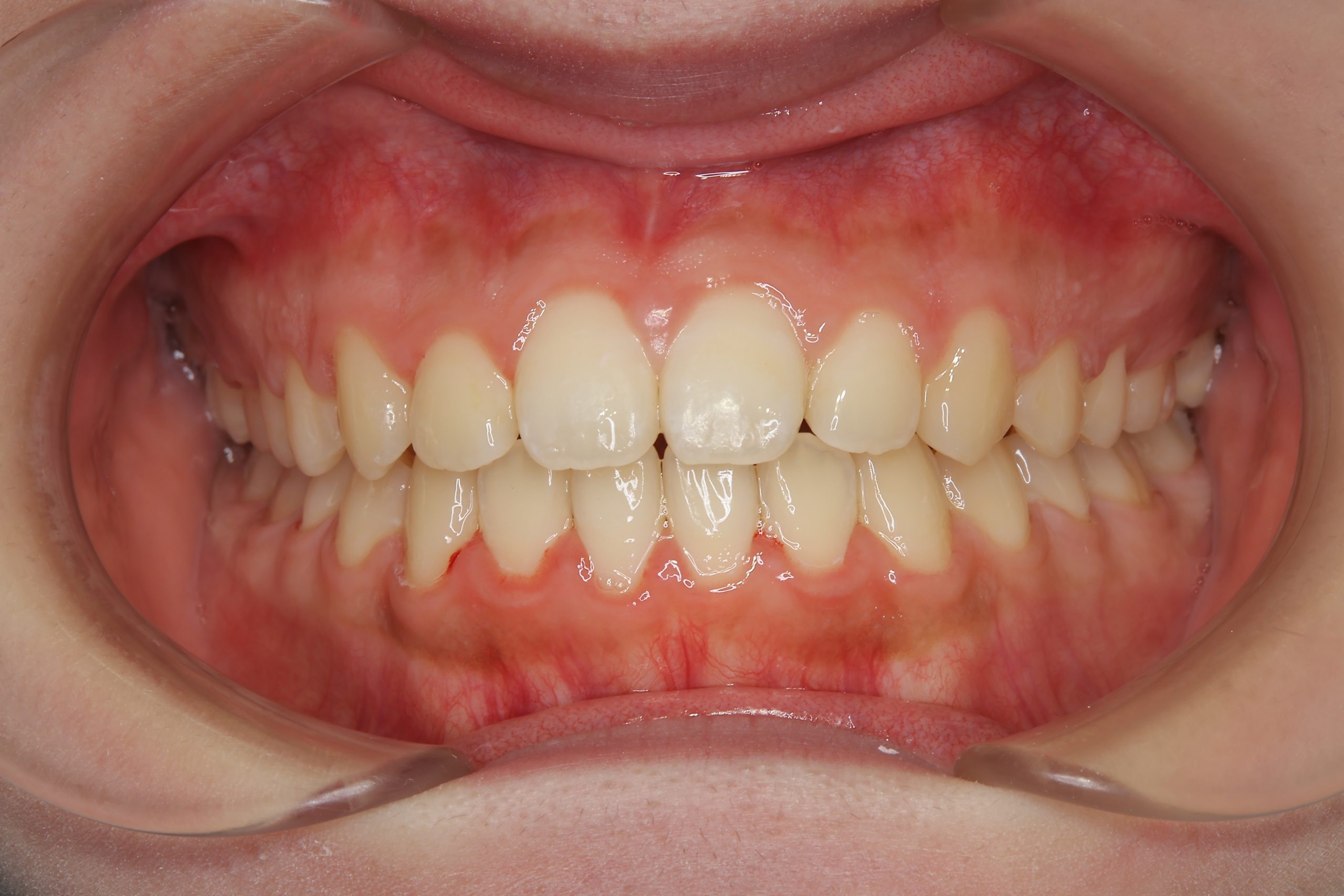 全顎ワイヤー矯正　症例_1409