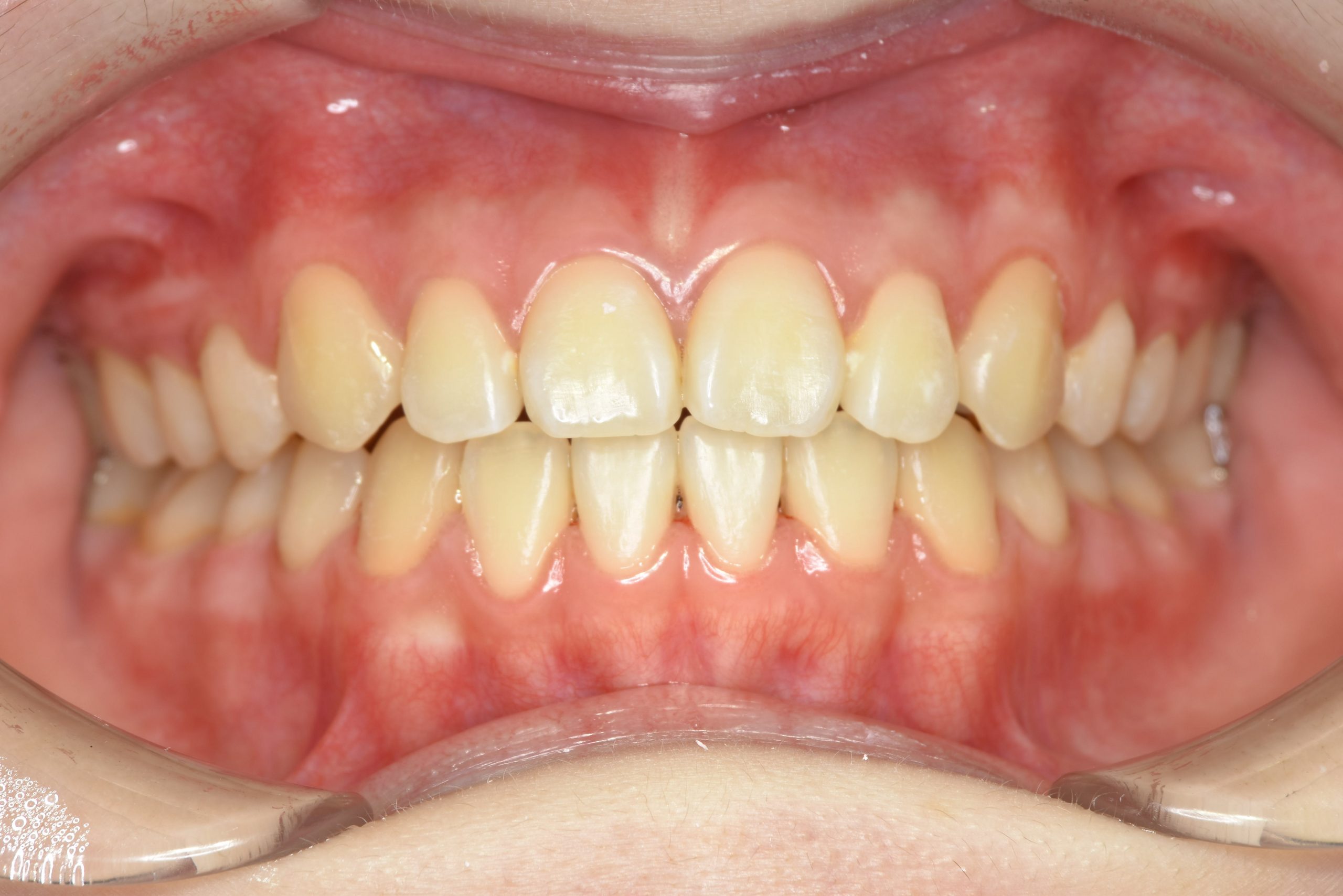 全顎ワイヤー矯正　症例_154