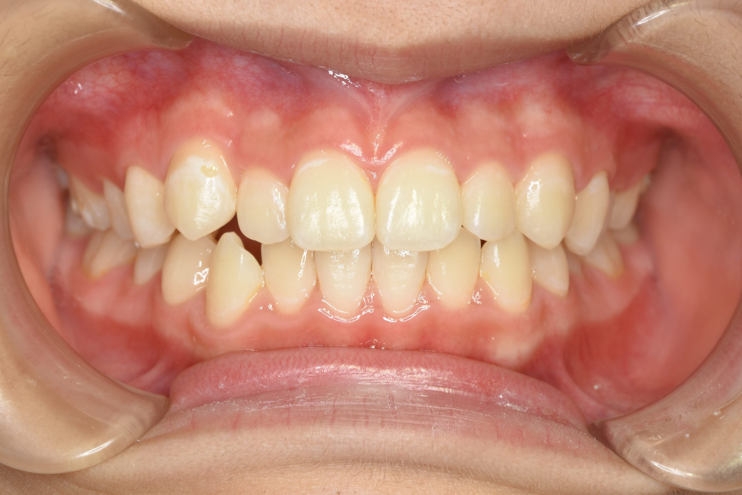 全顎ワイヤー矯正　症例_169