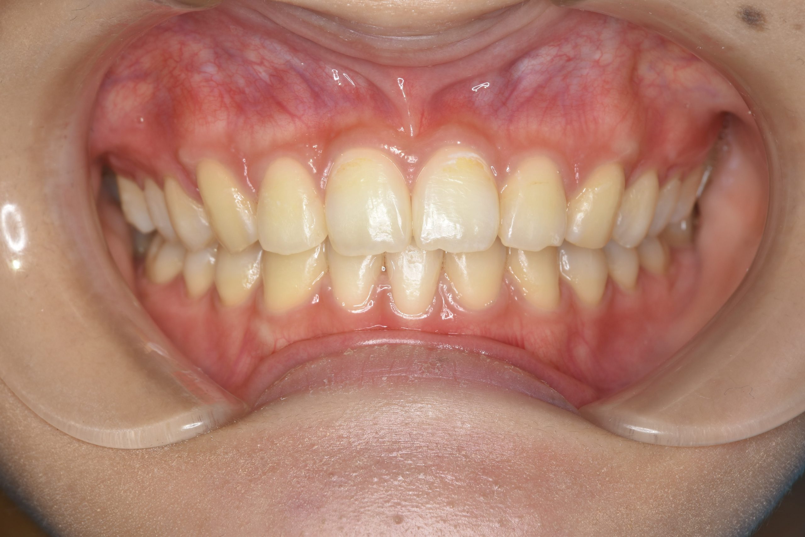 全顎ワイヤー矯正　症例_182