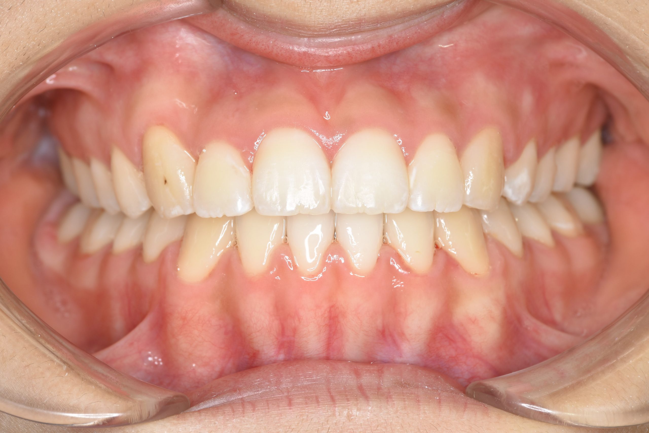 全顎ワイヤー矯正　症例_29