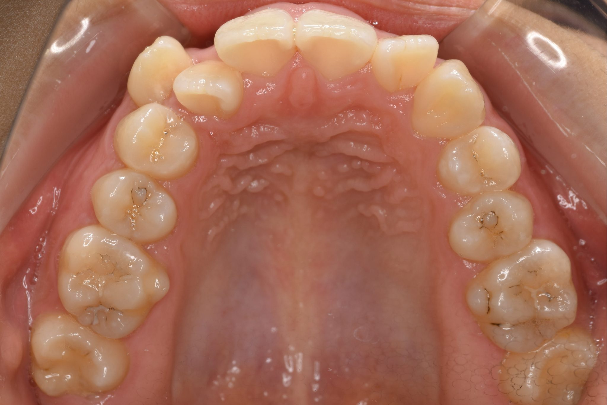 全顎ワイヤー矯正　症例_29