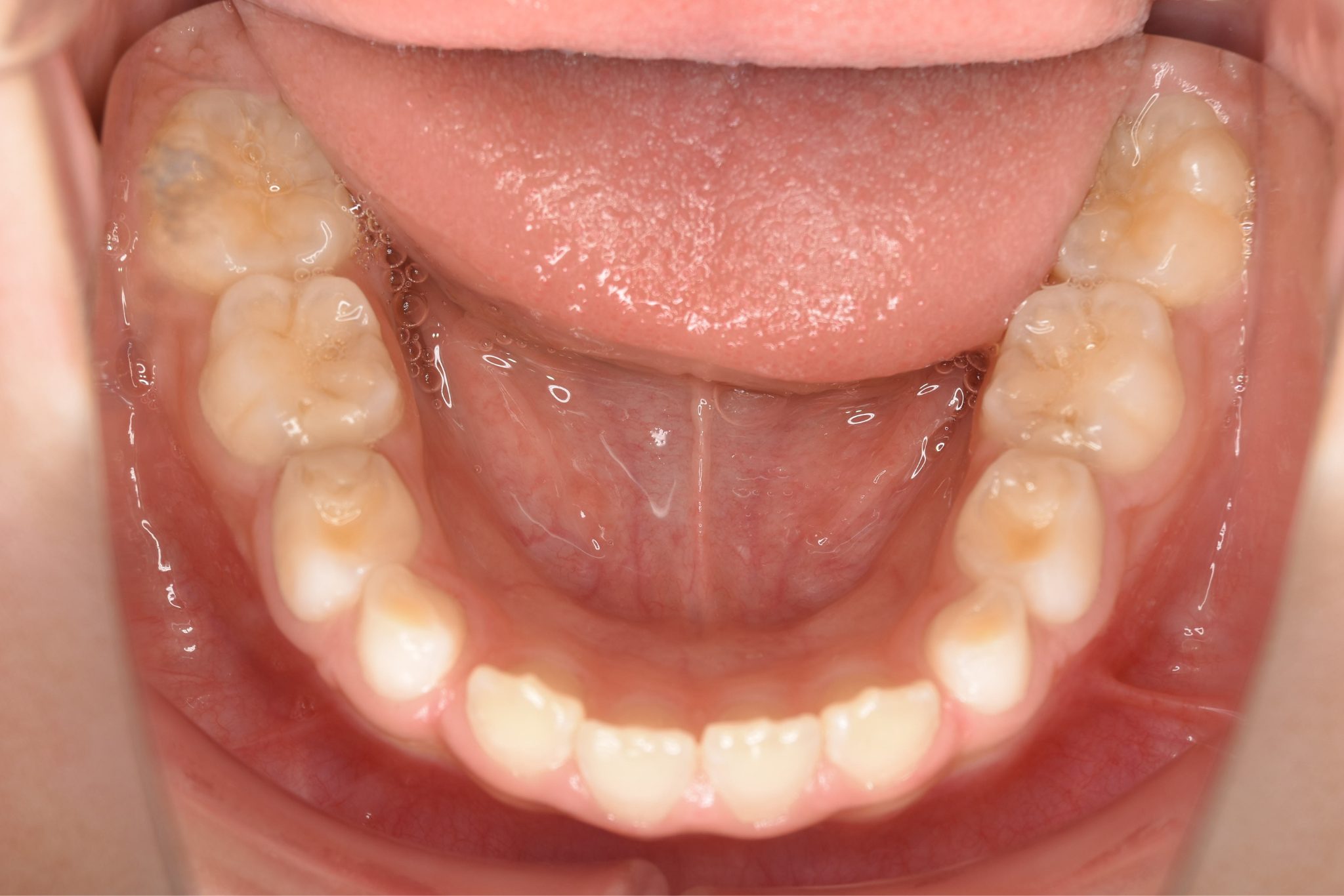 全顎ワイヤー矯正　症例_108