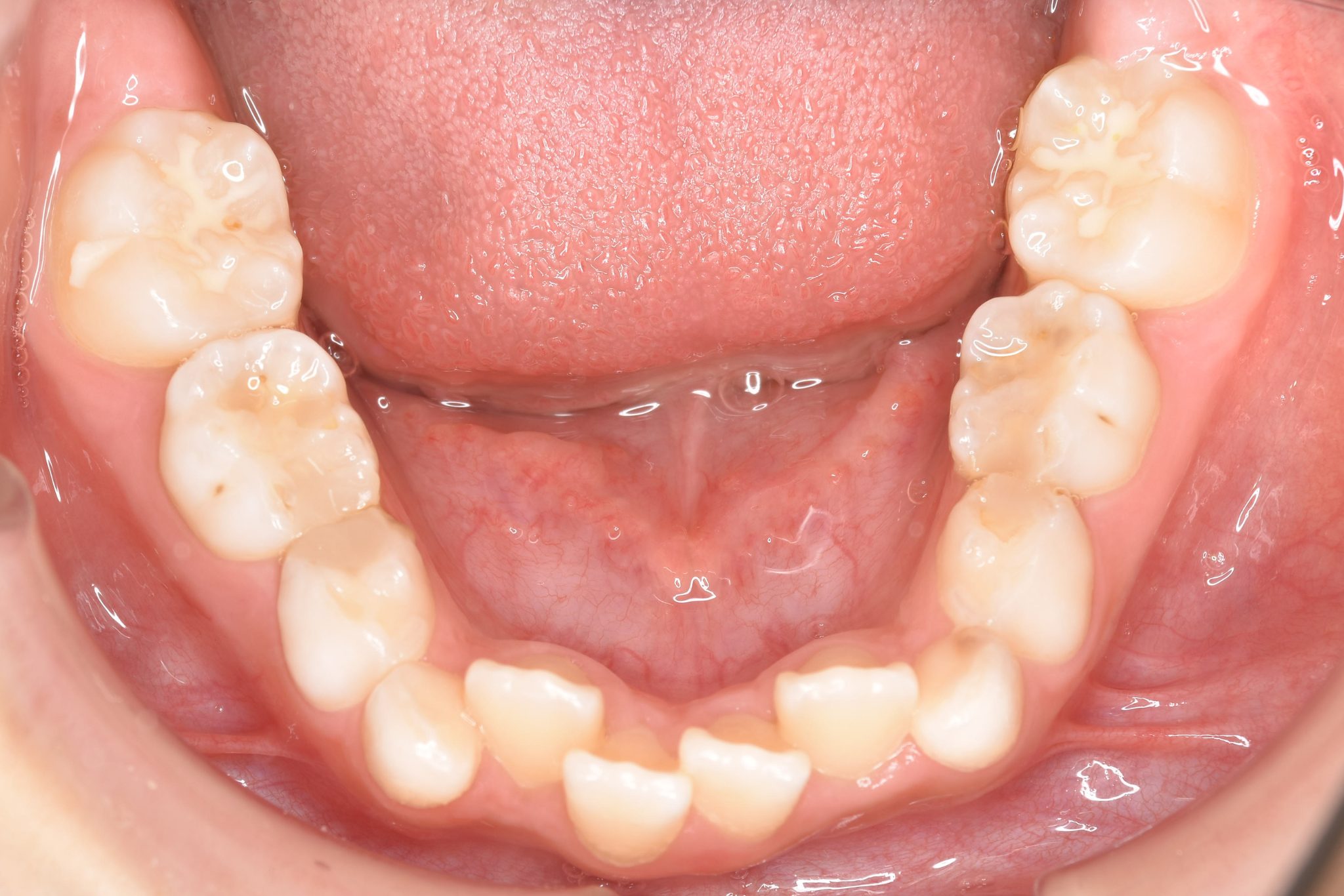 全顎ワイヤー矯正　症例_185