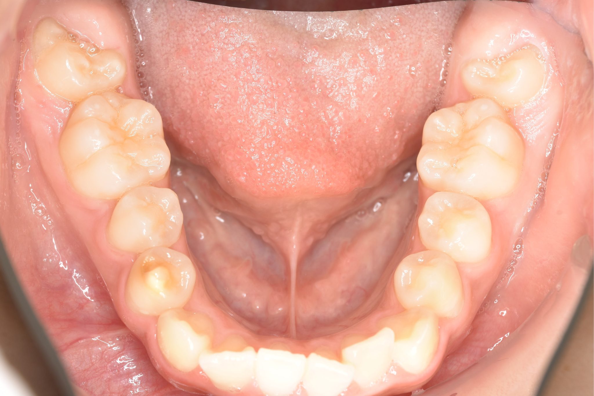 全顎ワイヤー矯正　症例_191