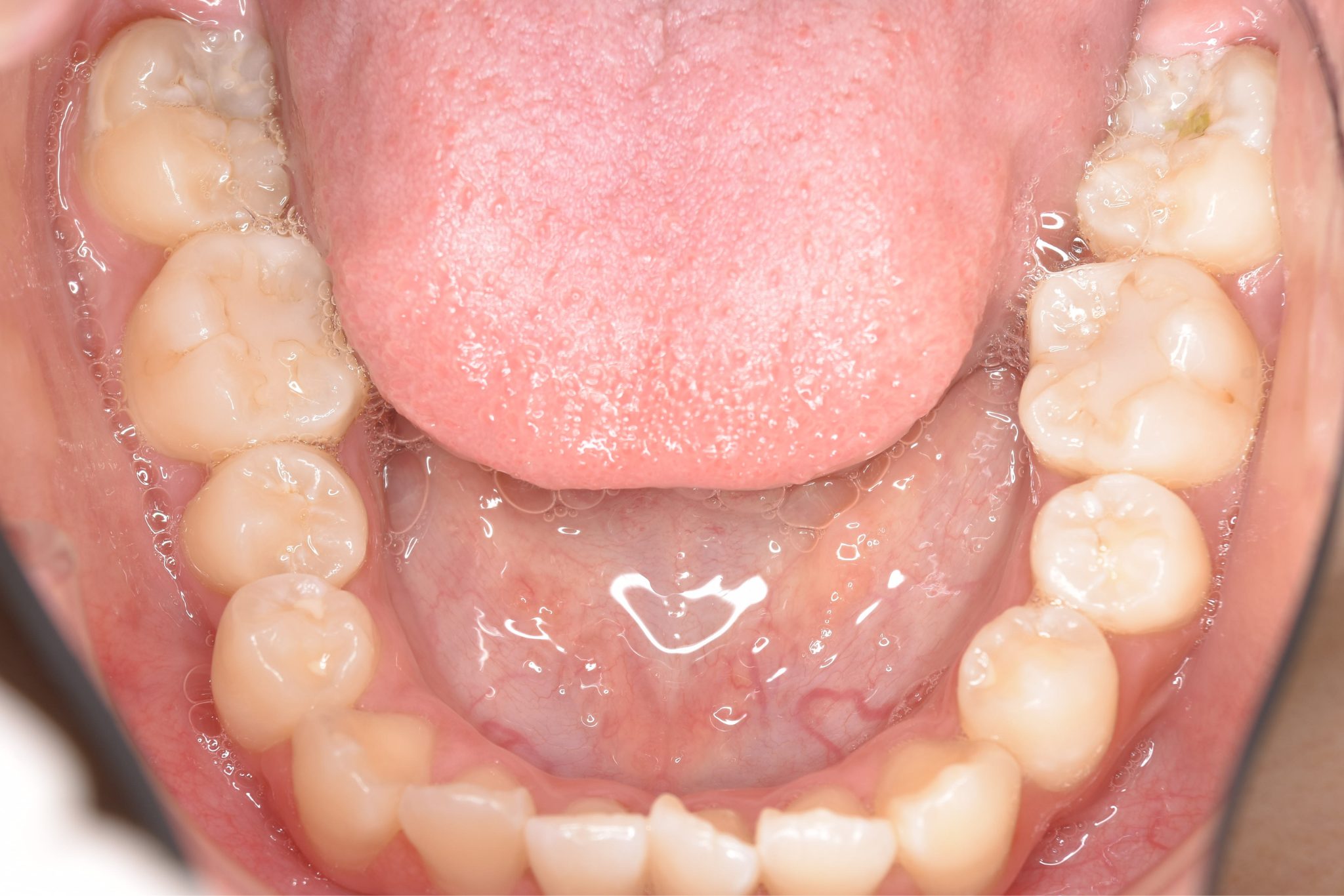 全顎ワイヤー矯正　症例_198