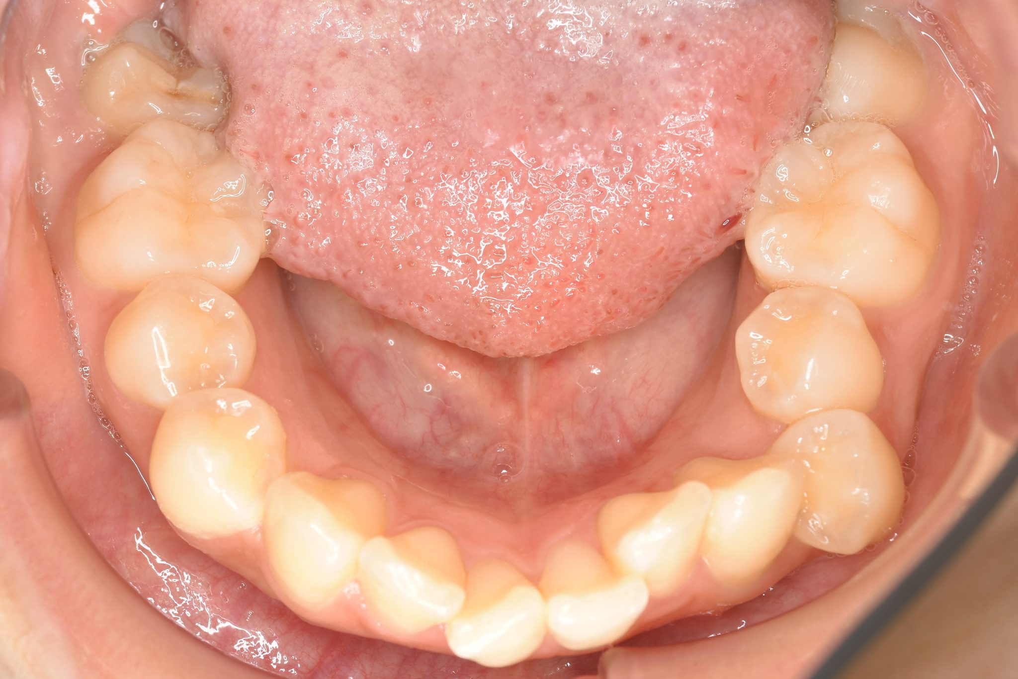 全顎ワイヤー矯正　症例_200