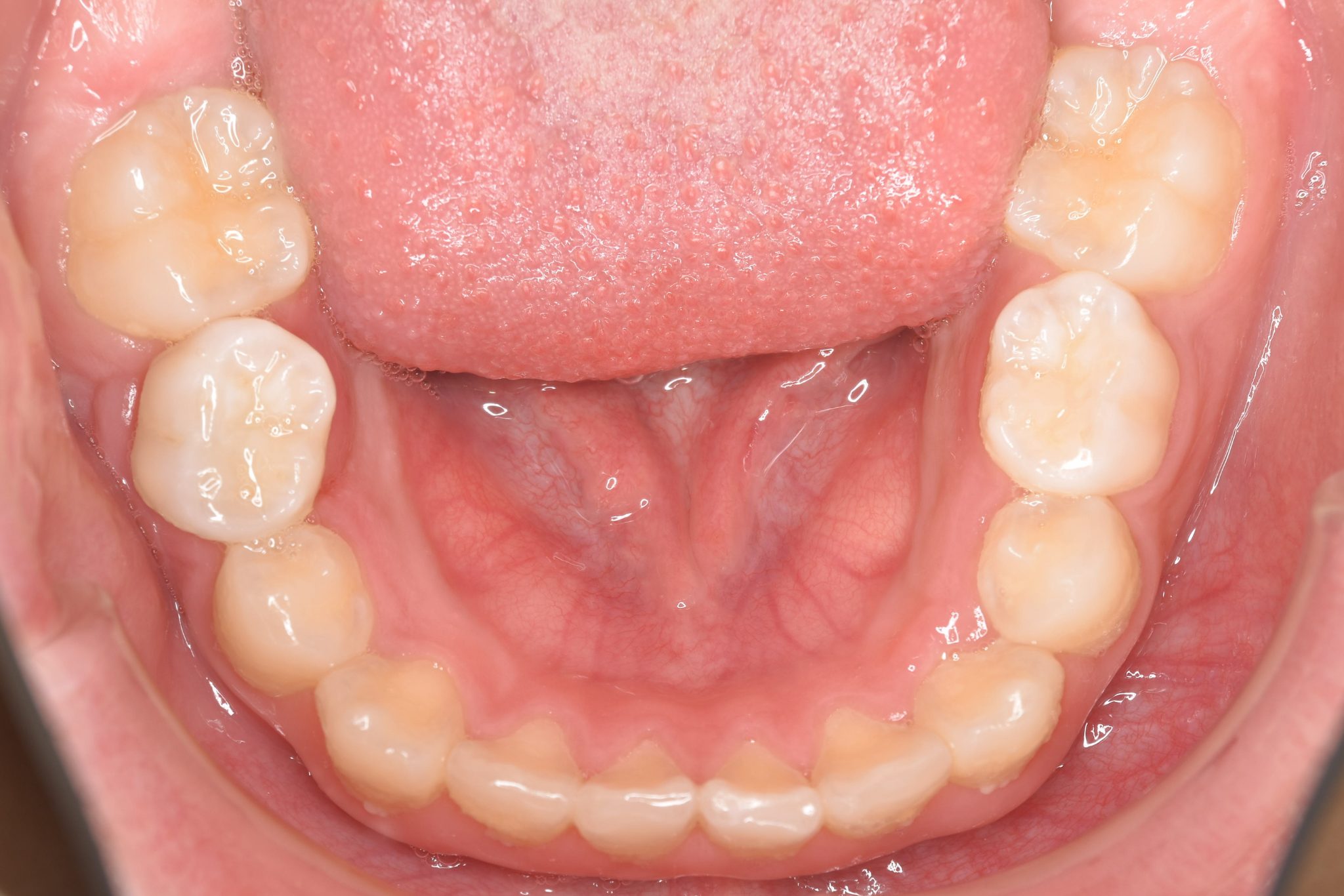 全顎ワイヤー矯正　症例_218