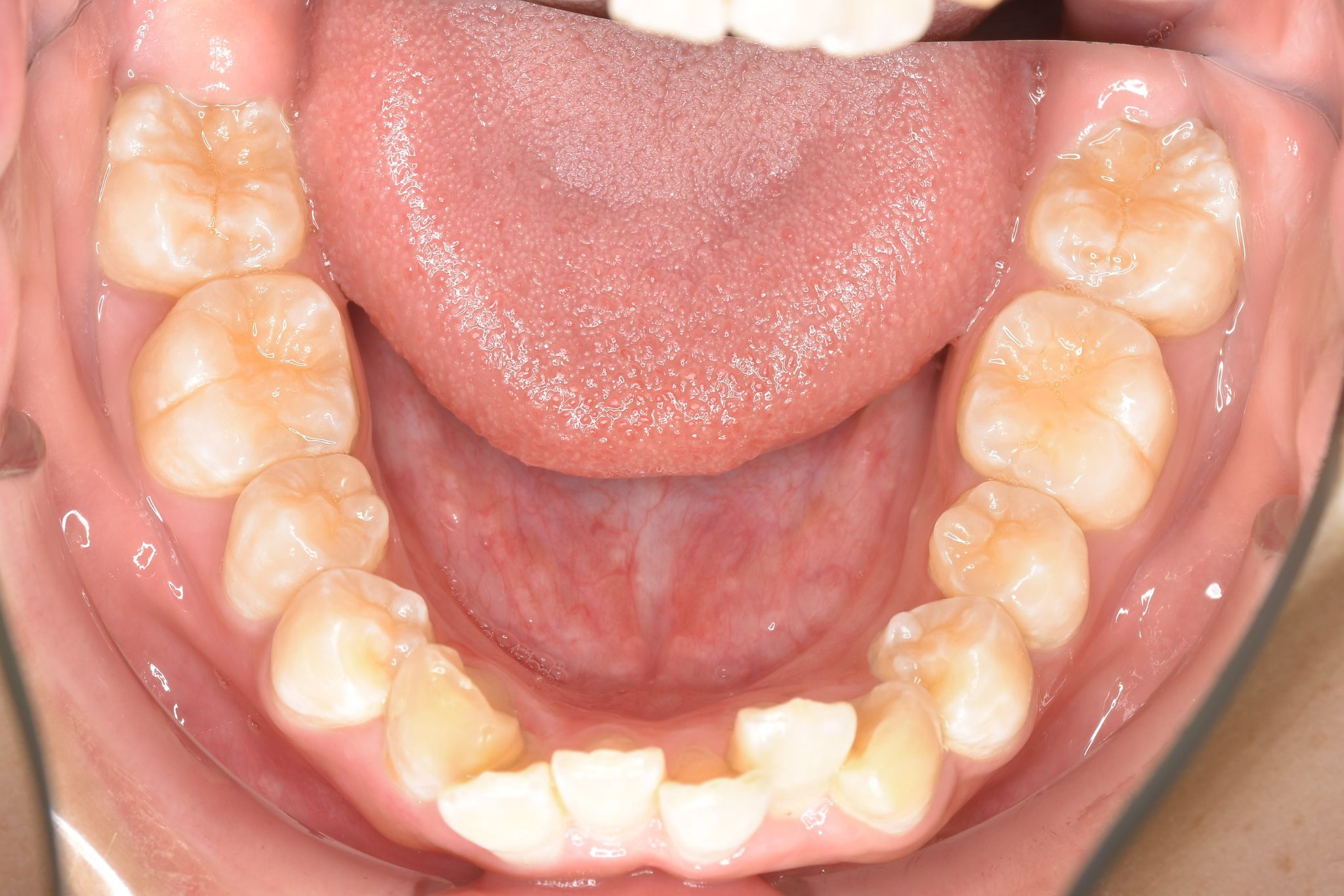 全顎ワイヤー矯正　症例_252