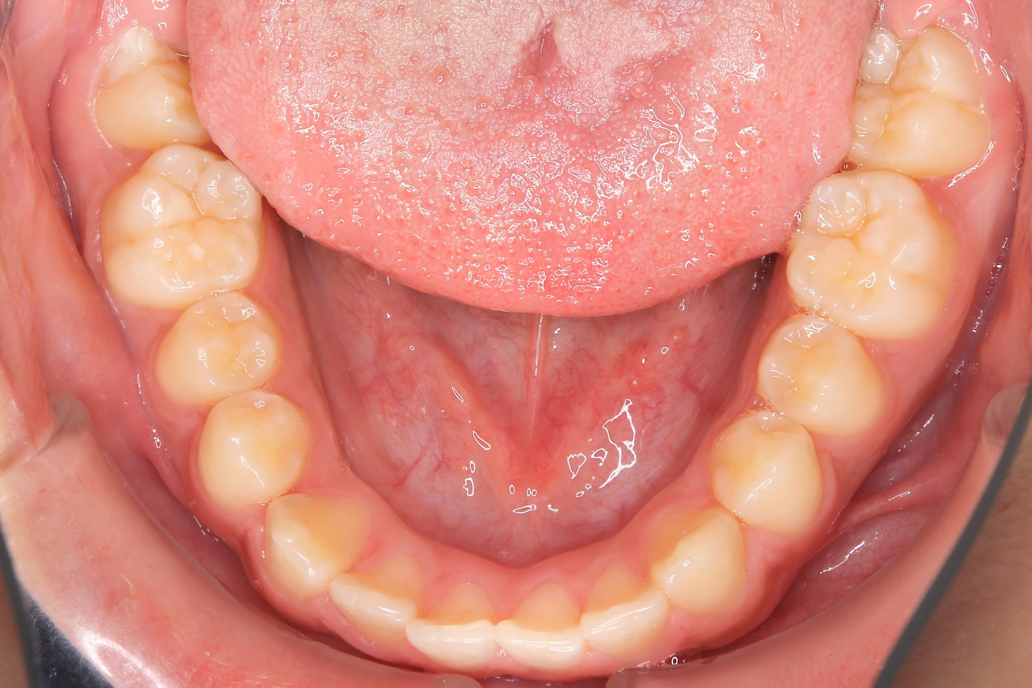 全顎ワイヤー矯正　症例_261