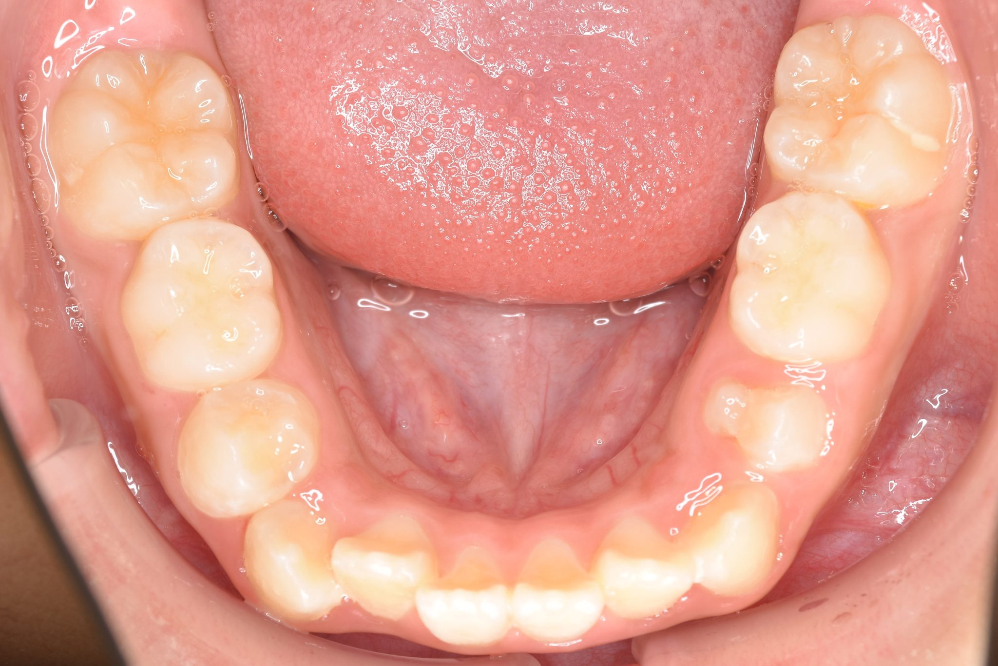 全顎ワイヤー矯正　症例_267