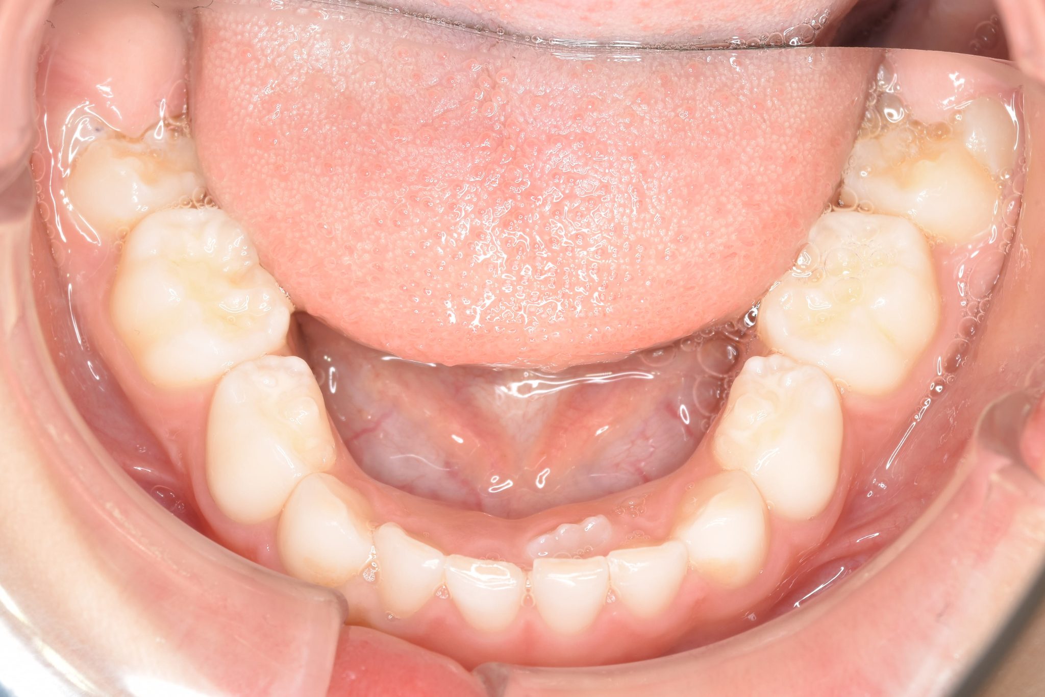 全顎ワイヤー矯正　症例_121