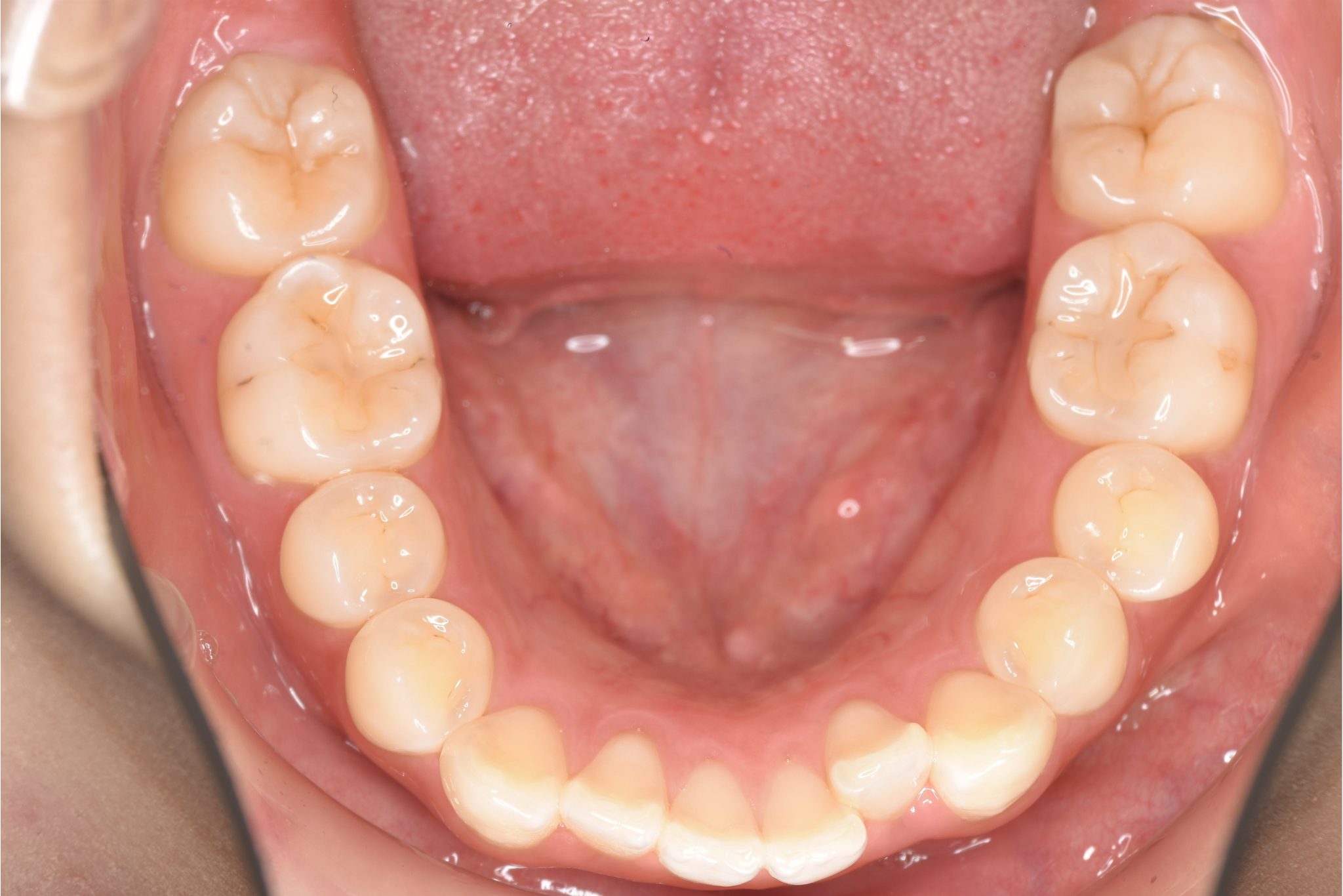 全顎ワイヤー矯正　症例_306